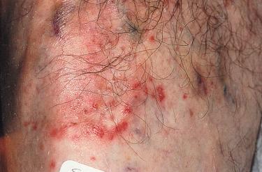 Figure 8.18, Folliculitis apparent 7 days after sclerotherapy. Compression of the treated area was produced with STD foam pads overlaid with Microfoam tape.