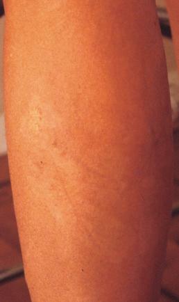 Figure 8.19, Skin tan fading after removal of adhesive tape and consecutive removal of superficial skin layers. Skin color gradient will disappear when suntan fades.