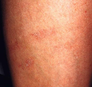 Figure 8.20, Epidermal dehydration by adhesive tape. Not to be considered as an allergy.