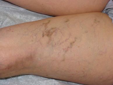 Figure 8.2, Linear pigmentation, no compression, 6 weeks after 0.25% sodium tetradecyl sulfate liquid sclerotherapy.