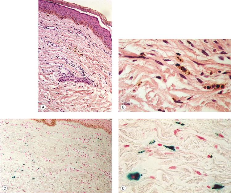 Figure 8.3, Section stained with hematoxylin–eosin taken 6 months after injection with polidocanol 0.75%. Note scattered foci of golden brown pigment. A, Original magnification ×50. B, Perls-stained section from the same patient shown in Figure 8.1 . Note scattered foci of green–blue granules within siderophages. Original magnification ×200. C, Original magnification ×350. D, Original magnification ×3200.