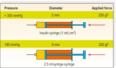 Figure 8.4, Pressure and syringe. Small syringes increase the risk of extravasation and necrosis (microarteriovenous fistulas, backflow injections).