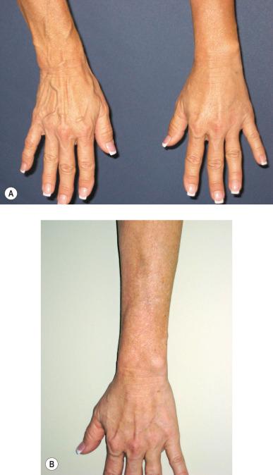 Figure 8.5, A, Appearance of dorsal hand veins (upper) 2 weeks after treatment with 1 mL of sodium tetradecyl sulfate 0.5% foam mixed 1 : 4 with room air. Note total resolution of the vein as compared with the untreated hand veins (below) and development of minor coagula in the treated dorsal hand vein. B, Six months posttreatment there is pigmentation on the dorsal distal arm from the sclerosing effect of the proximal dorsal hand vein.