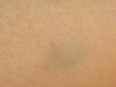 Figure 8.6, Thirty-two-year-old woman who had undergone sclerotherapy for telangiectasia on the thigh with sodium tetradecyl sulfate 0.25% 6 months previously. She presented with a bluish discoloration overlying the treated area, which was devoid of telangiectasia. Her history disclosed that she was taking minocycline 100 mg b.i.d. prescribed by her dermatologist 3 months earlier for acne eruption. Discontinuation of the minocycline resulted in resolution of the pigmentation. No biopsy was taken to confirm the diagnosis of minocycline pigmentation, but the clinical course and history supported the diagnosis.