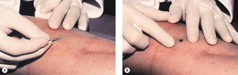 Figure 8.7, Method for evacuation of a thrombosis in a 1-mm diameter reticular varicose vein 2 weeks after sclerotherapy. A, Small incision. B, Expelling clot (see text for details).