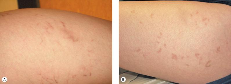 Figure 8.9, A, Telangiectasia treated by a nurse not under physician supervision. Treatment was carried out with a DioLite 532 laser (Iridex, Mountain View, CA) at 13 J/cm 2 , 3 W and 1000-µm spot size at 5 Hz with a total of 5856 pulses to the leg veins. Note extensive hyperpigmentation over the treated veins 2 months posttreatment. B, This pigment failed to resolve over 9 months of topical application of Tri-Luma cream (Galderma Laboratories, Fort Worth, TX), after which the patient was lost to follow-up.