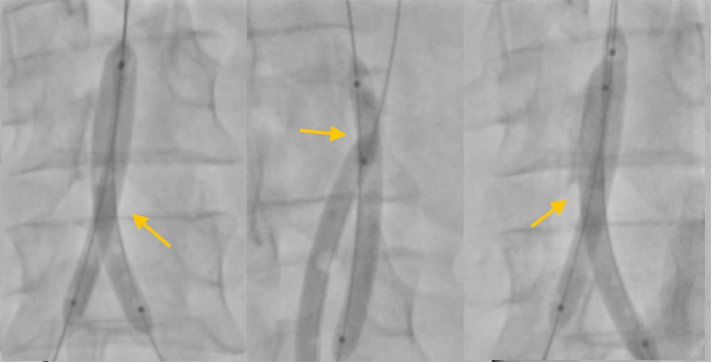 Fig. 24.1, Endovascular Scissoring.