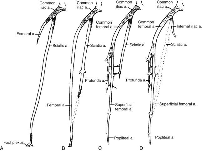 FIGURE 1, The embryologic development of the lower extremity arterial circulation. A, Complete sciatic artery. B, An early femoral artery and regression of the sciatic artery. C, Continued femoral artery growth. D, Normal femoral artery and former sciatic artery (dotted line) showing the sciatic artery’s contribution to the internal iliac, profunda, and popliteal arteries.