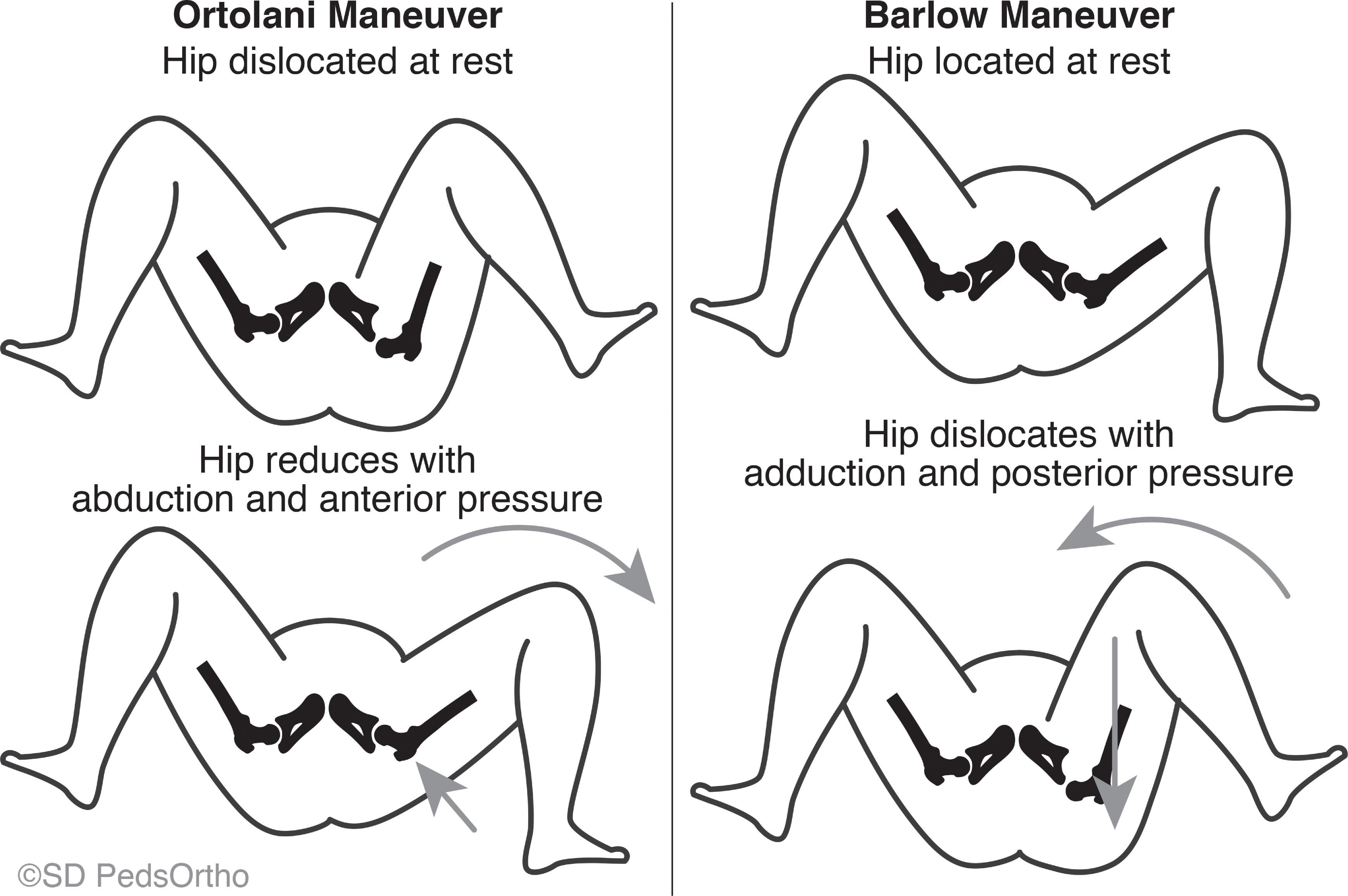 Fig. 27.1, Drawings Demonstrating Ortolani Maneuver ( Left ) and Barlow Provocative Maneuver ( Right ) for Diagnosing Infantile Hip Instability (Developmental Dysplasia of the Hip).