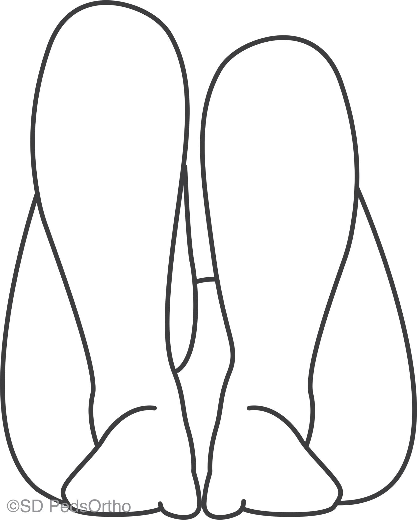 Fig. 27.2, The Galeazzi Sign is Often Positive in a Child With a Unilateral Hip Dislocation. The asymmetric heights identified at the knee level indicate that the hip on the shorter limb may be dislocated posteriorly.