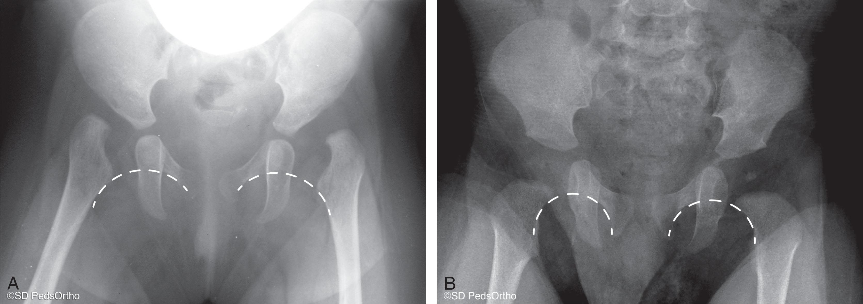 Fig. 27.3, (A) Anteroposterior pelvis radiograph of a 6-month-old child with bilateral high hip dislocation. A radiologist read the films as “normal.” Note that in high bilateral dislocations it may appear that Shenton’s line is intact because the hips are externally rotated in this view, and the greater trochanteric area can look like the calcar of the femoral neck. (B) Correct drawing of Shenton’s line in a patient with “normal” hips.