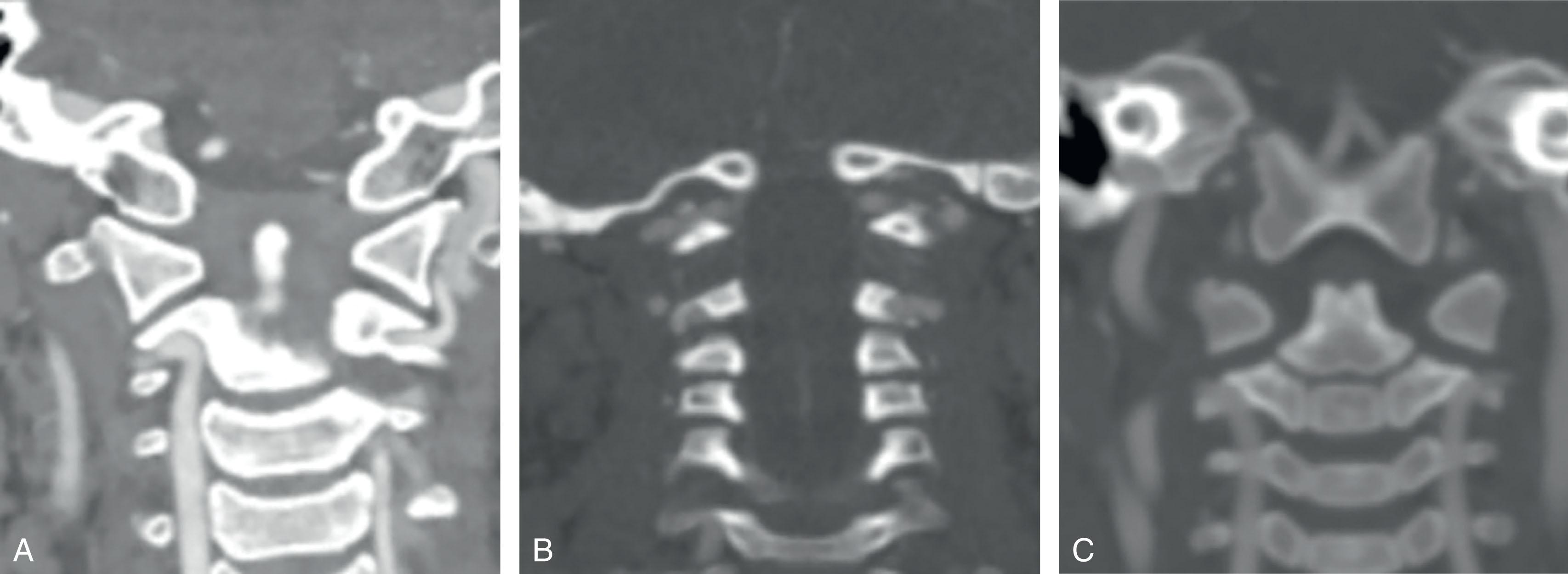 Fig. 8.3, Coronal Computed Tomography Angiography Images Illustrating Variability of Vertebral Artery Course. Each image displays variable vertebral artery curvature at the C2 foramen. (A) Prominent portion of the intra-axial vertebral artery above the level of outlet of the C2 transverse foramen. (B) Within the C2 transverse foramen. (C) Below the C2 transverse foramen.