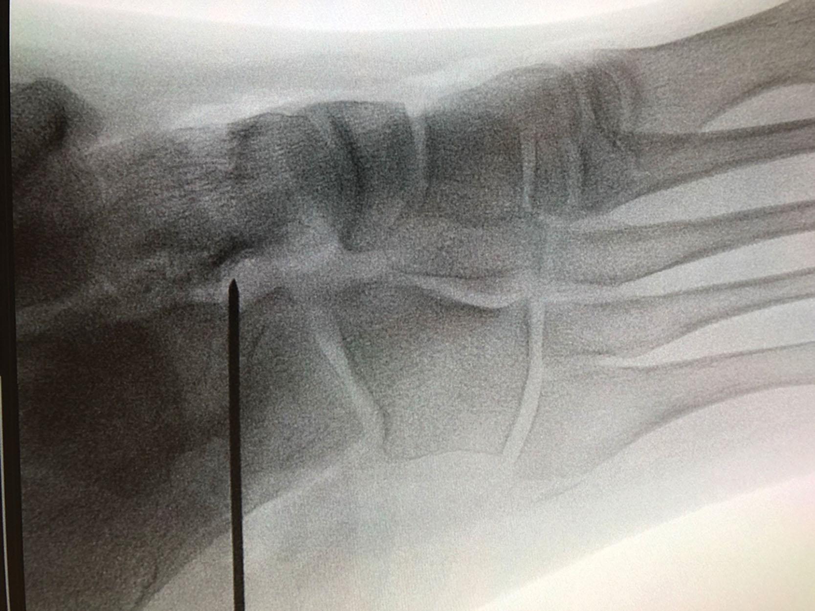 Fig. 35.1, Proper Position of Steinmann Guide Pin. This is for calcaneal-lengthening osteotomy starting laterally at the critical angle of Gissane and ending medially at the posterior edge of the interval between the anterior and middle facets.