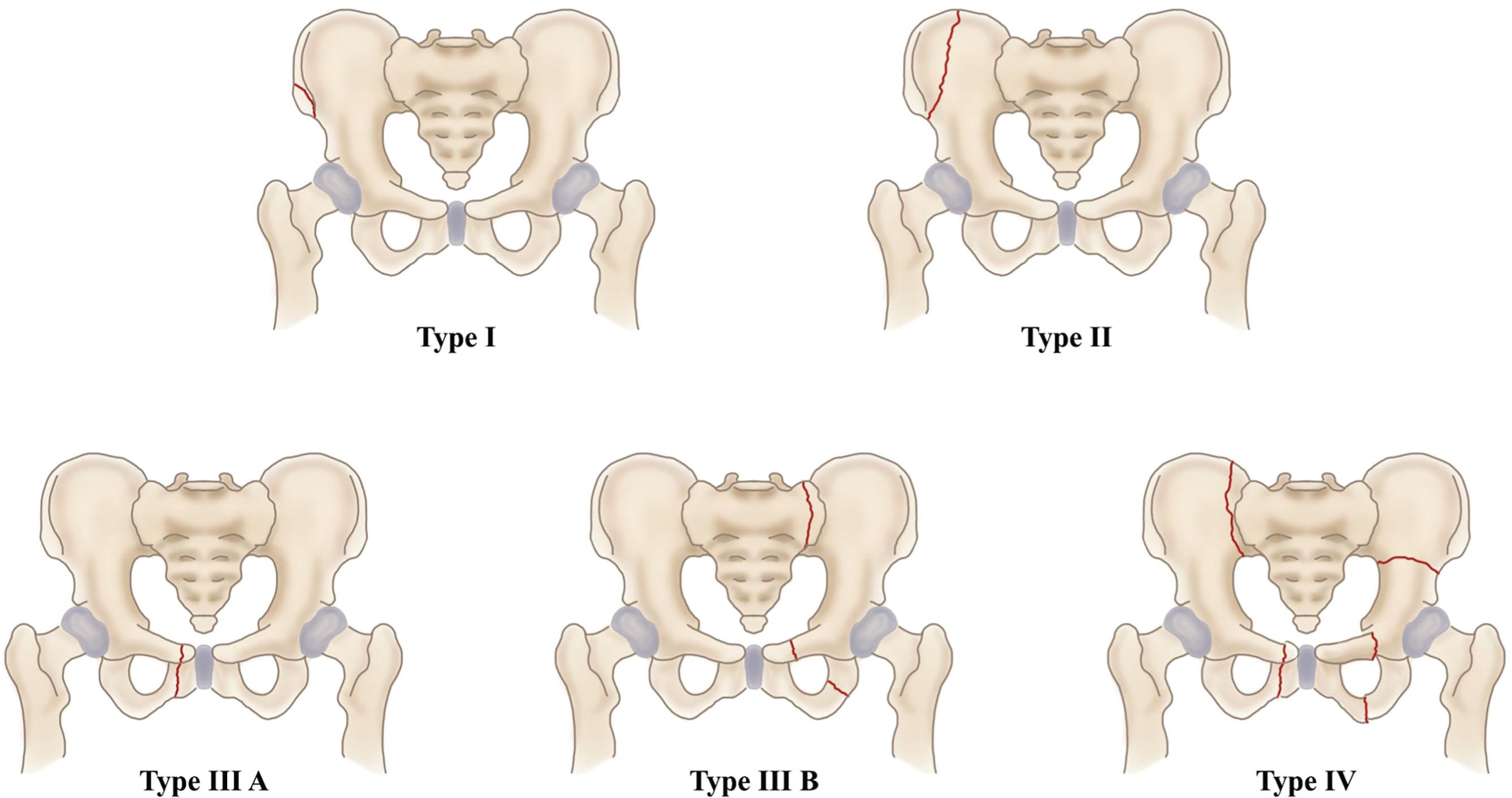 Fig. 10.1, Modified Torode and Zieg Classification of Pelvic Fractures in Children. Torode I (avulsion fractures): Avulsion of the various bony elements of the pelvis, either through or very close to the cartilaginous growth plate. Torode II (iliac wing fractures): Disruption of the iliac apophysis or an infolding fracture of the iliac wing from a direct lateral force against the pelvis. Torode III A (simple anterior ring fractures): Stable anterior fractures involving the pubic rami or pubic symphysis. Torode III B (stable anterior and posterior ring fractures): Both anterior and posterior ring fractures that are stable. Torode IV (unstable ring disruption fractures): Unstable pelvic fractures, including ring disruptions, hip dislocations, and combined pelvic and acetabular fractures.