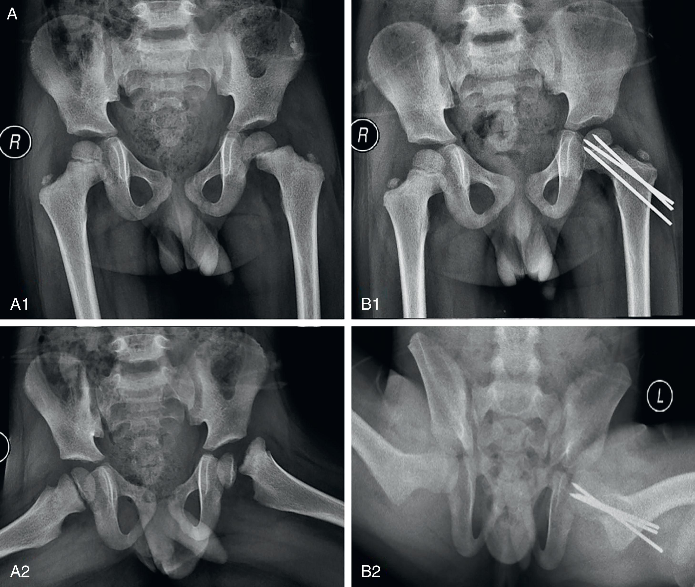 Fig. 10.2, (A) Type 1 fracture. A 3-year-old boy fell on the trampoline and subsequently complained of left hip pain. A1 and A2: Hip radiographs revealed a Delbet type 1 transepiphyseal fracture neck femur. B1 and B2: X-ray shows anatomical reduction and internal fixation of fracture with pins. (B) Type 2 fracture. A 14-year-old boy fell from his bike and was unable to stand. He was brought to the emergency room with severe left hip pain. A1 and A2: Hip radiographs showing Delbet type 2 fracture neck of femur. B: Anteroposterior radiograph of the hip showing anatomical reduction and fixation with sliding hip plate screw construct with an additional derotation screw. (C) Type 3 fracture. A 10-year-old boy had a road traffic accident and was brought to the emergency room with right hip pain. A: Pelvis radiograph showing Delbet type 3 fracture neck of femur. B1 and B2: Hip radiograph showing complete healing of fracture 3 months after injury. The fracture was fixed with a sliding hip plate screw construct with an additional derotation screw. (D) Type 4 fracture. A 7-year-old boy was hit by a bus and was brought to the hospital with severe right hip pain. A1 and A2: Radiographs showing Delbet type 4 neck femur fracture in children. B1 and B2: Postoperative hip radiographs showing anatomical reduction and plate screw construct.