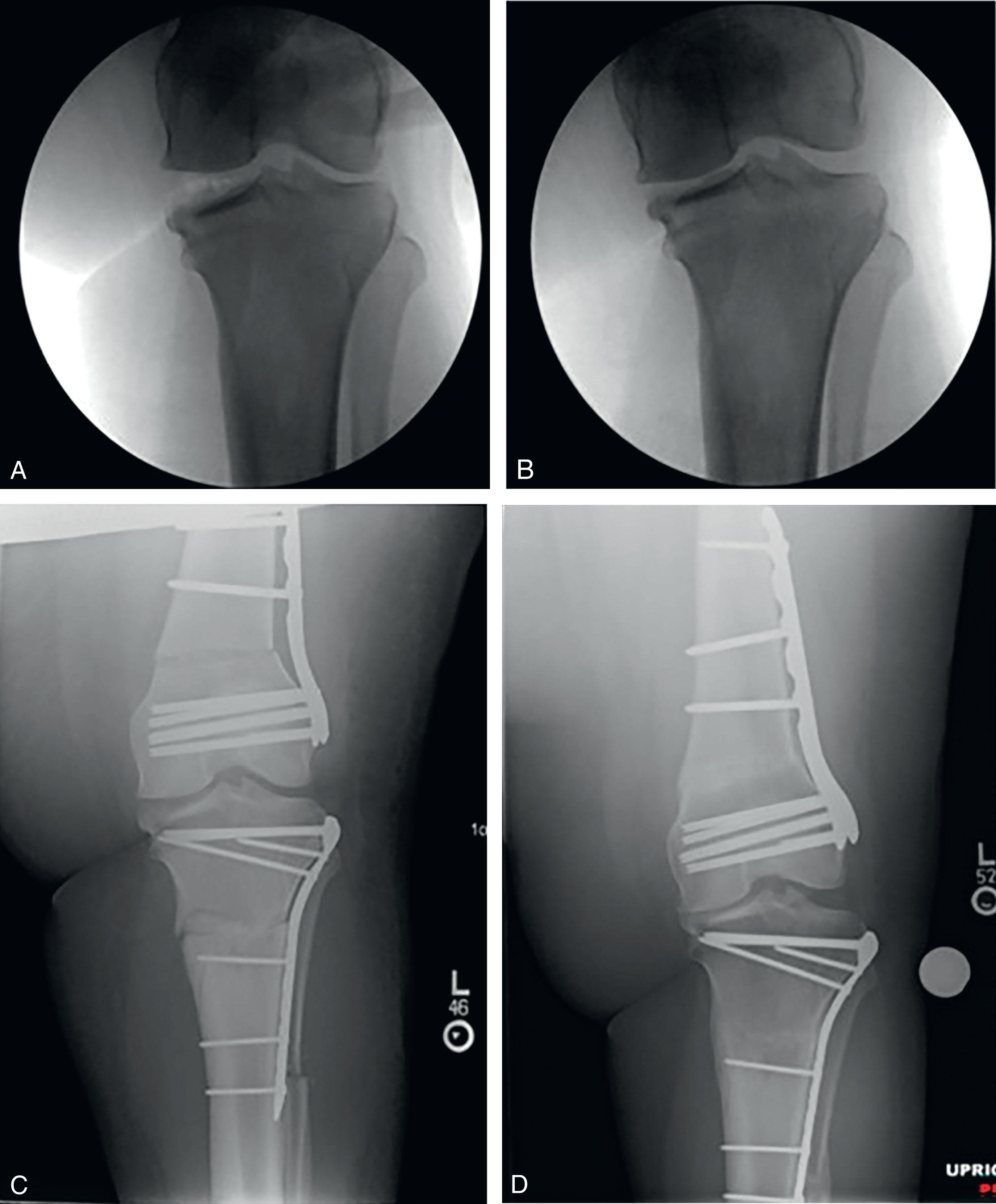 Fig. 32.1, (A and B) Intraoperative coronal plane stress exam, demonstrating fibular collateral ligament (FCL) laxity on varus stressing. (C) The surgeon planned the tibial correction based on the alignment of the tibial plateau and did not incorporate the degree of FCL laxity. Immediate postoperative radiograph demonstrates satisfactory alignment of the distal femur and proximal tibia acute corrections. (D) At 2 years postsurgery, the varus laxity has now resulted in recurrent genu varum with increased joint line convergence.