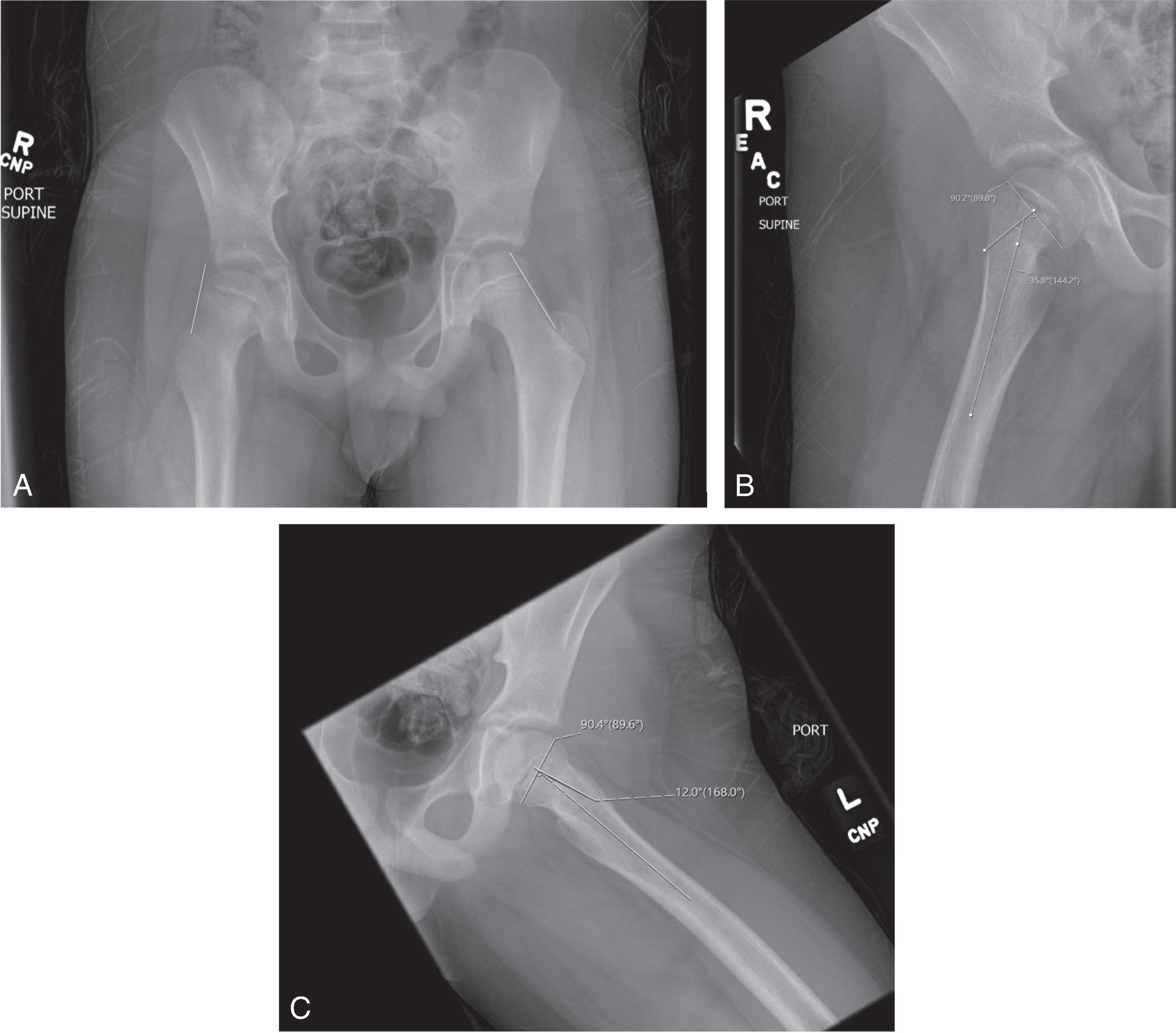 Fig. 31.2, Radiology Measures of Slipped Capital Femoral Epiphysis (SCFE). (A) Klein’s line: Klein’s line is drawn over superior neck on an anteroposterior pelvis radiograph. A SCFE is present if the line passes above (right hip) rather than through the epiphysis (normal left hip). (B and C) Southwick angle. On the frog lateral radiograph, the slip angle described by Southwick angle can be calculated from the angle between the femoral shaft and a line perpendicular to the proximal femoral physis, which is then compared between the (B) affected and (C) normal hips. In the case of bilateral slips, 12 degrees can be used as the “normal” value to determine the severity of slip. (B) The example above shows a mild chronic stable SCFE of the right hip with a slip angle of 24 degrees (36 – 12).