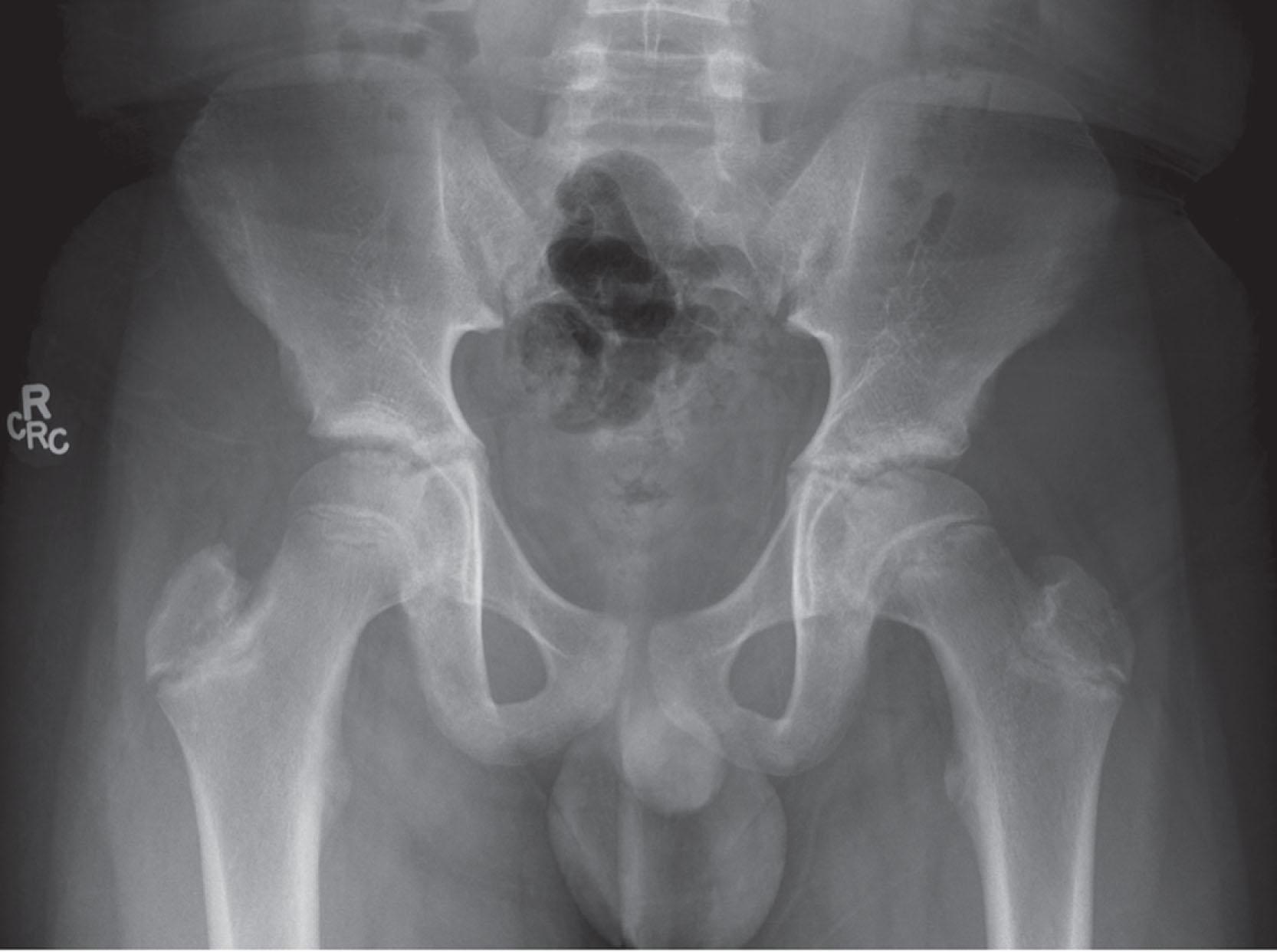 Fig. 31.3, Epiphyseal Tubercle. The irregular contour of the physis provides innate stability. Metaphyseal resorption due to abnormal mechanical stress focused about the epiphyseal tubercle may lead to enlargement of the metaphyseal socket and contribute to epiphyseal instability. This 11-year-old with a left slipped capital femoral epiphysis demonstrates widening and irregularity of the physis, particularly the epiphyseal tubercle, compared to the normal right hip.