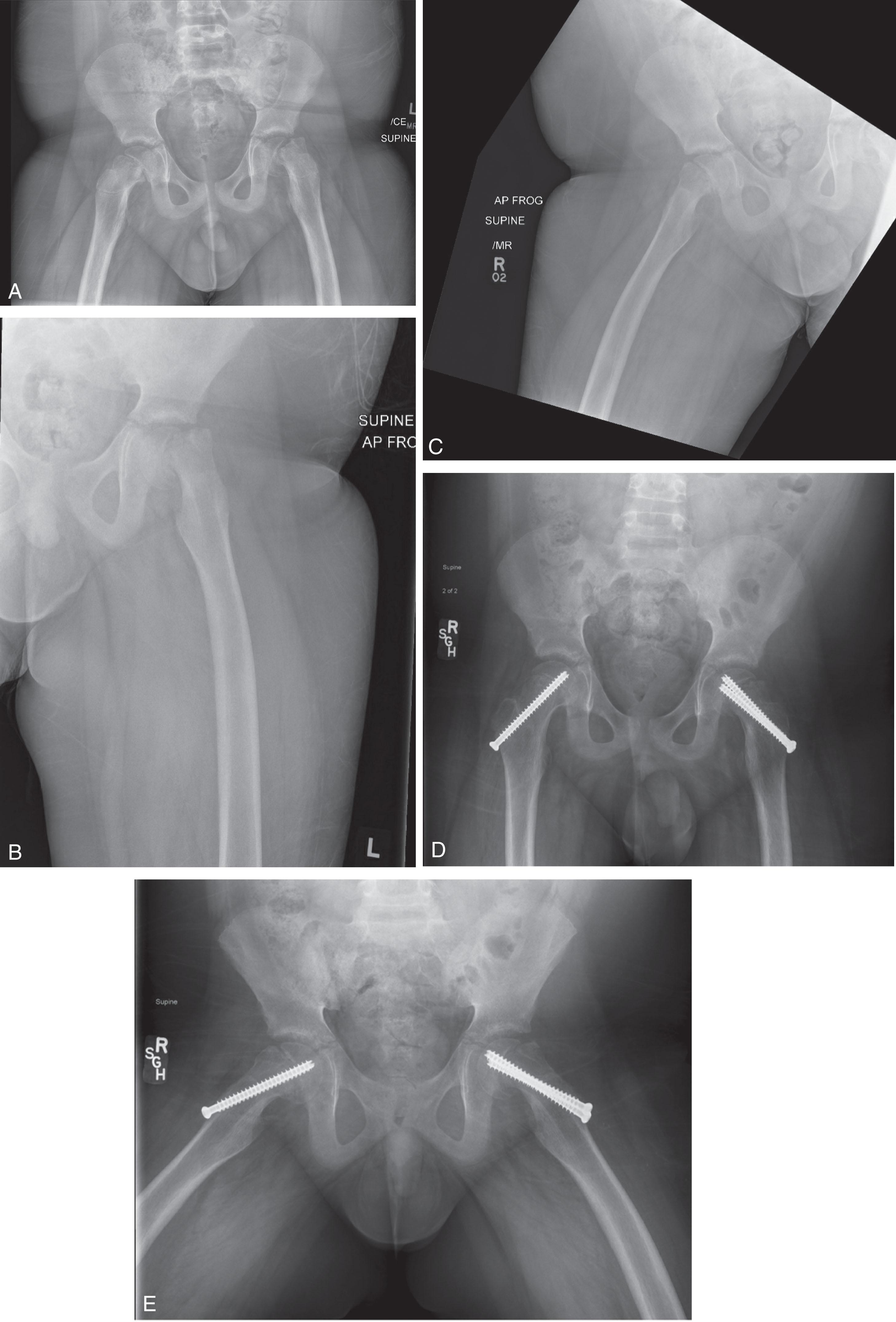 Fig. 31.4, Example of bilateral Slipped Capital Femoral Epiphysis (SCFE), Right Stable and Left Unstable. A 10-year-old presenting with bilateral SCFE, right chronic stable (5 months of right knee pain and limp) and left acute unstable (2 days of left knee pain, fall and sudden inability to bear weight). (A) Anteroposterior pelvis radiograph demonstrates disruption of Klein’s lines. (B) Left hip frog lateral radiograph shows a severe SCFE. (C) Right hip frog lateral radiograph shows a milder SCFE. (D and E) Urgent in situ fixation of right hip and open partial reduction, anterior decompression, and screw fixation of the left hip were performed within 24 hours of the fall.