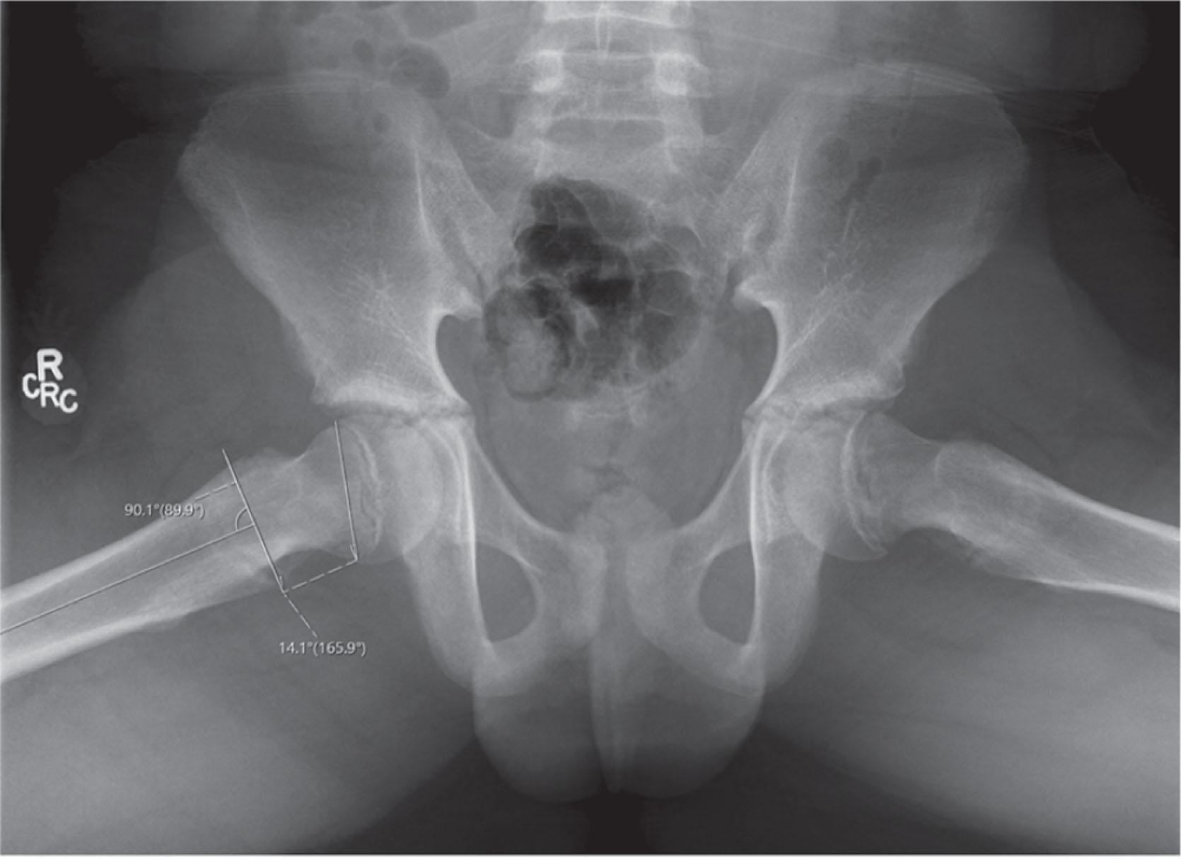 Fig. 31.5, Posterior Sloping Angle (PSA). PSA is defined as the angle between a line drawn across the physis and the perpendicular to a line drawn from the center of the femoral shaft down the center of the metaphysis on the frog lateral view. If prophylactic fixation is performed when PSA is 14 degrees or more, the number needed to treat is 1.79 to prevent 83% of contralateral slips.