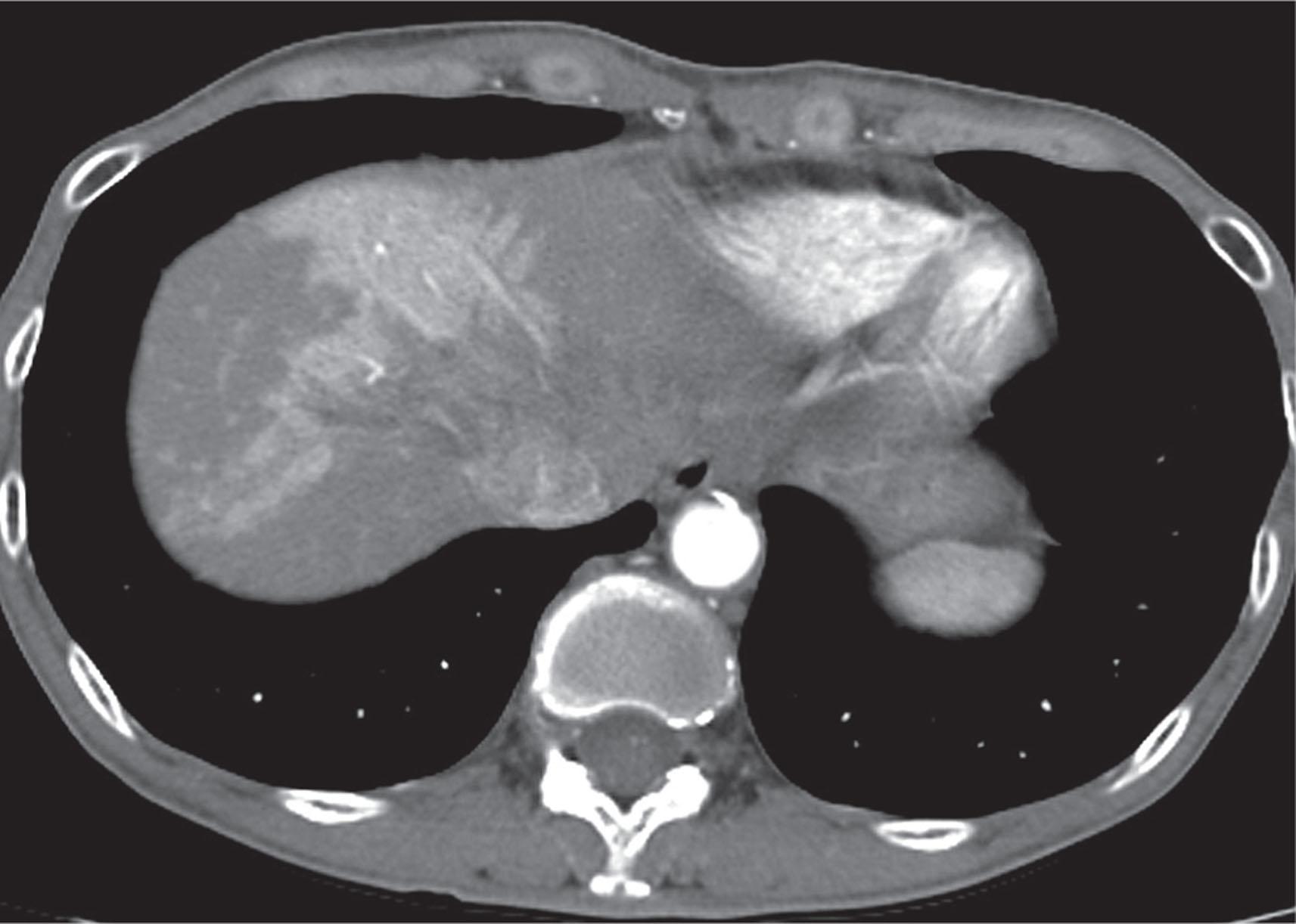 Figure 41.1, Axial contrast-enhanced computed tomography scan of the liver from a patient with lung cancer receiving chemotherapy with erlotinib shows perfusion abnormality and fatty infiltration. Changes were not seen before chemotherapy.