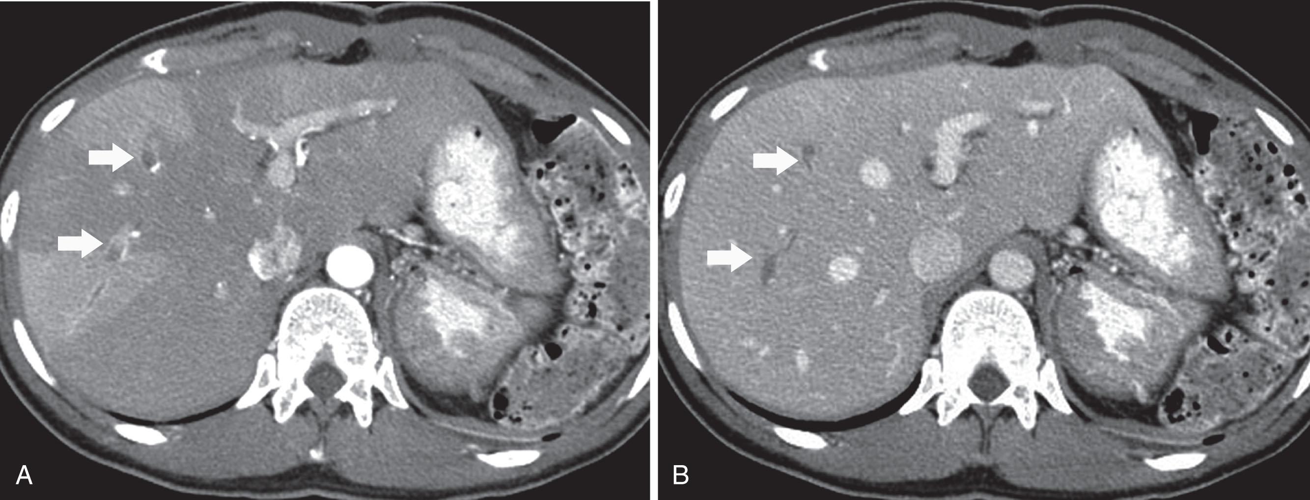 Figure 41.2, Axial contrast-enhanced computed tomography scans of the liver from a patient with colorectal carcinoma. A , Arterial phase scan shows wedge-shaped perfusion abnormalities and filling defects within the portal veins (arrows). B , In the portal venous phase the perfusion abnormalities are no longer visualized, but the portal vein filling defects are still seen (arrows).