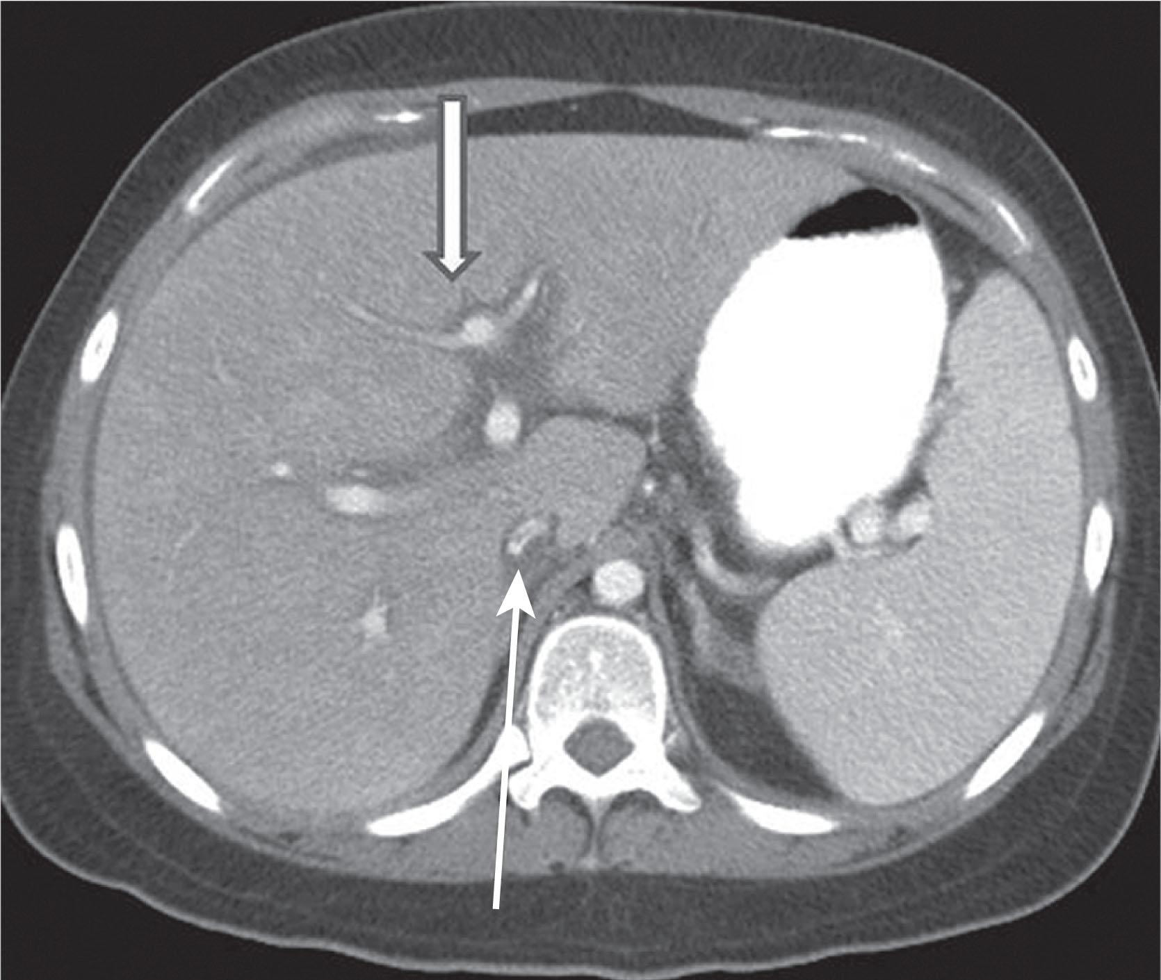 Figure 41.3, Axial contrast-enhanced computed tomography scan of the liver from a patient with colorectal carcinoma. There is periportal edema (thick arrow) and narrowing of the right hepatic vein (thin arrow).