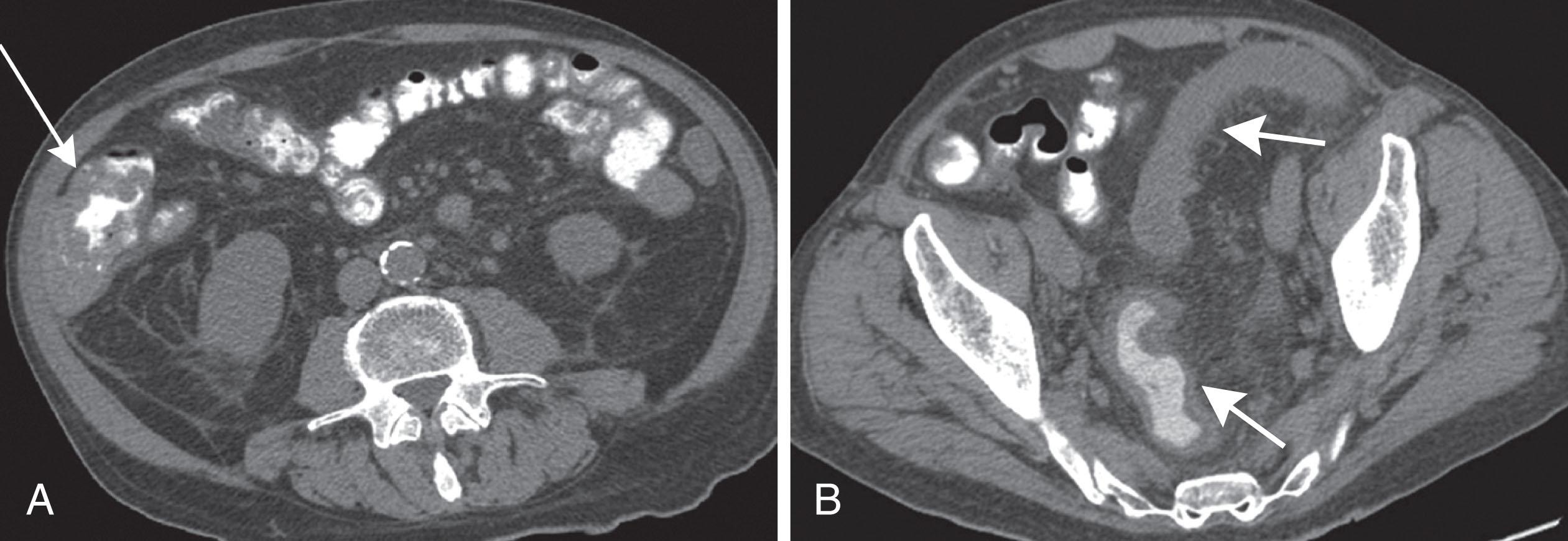 Figure 41.6, Axial contrast-enhanced computed tomography scans from a patient with leukemia 150 days after allogenic stem cell transplant. There is diffuse thickening of the cecum ( arrow ) and transverse colon (A) and rectosigmoid ( arrows in B ), which was biopsy-proven graft-versus-host disease.