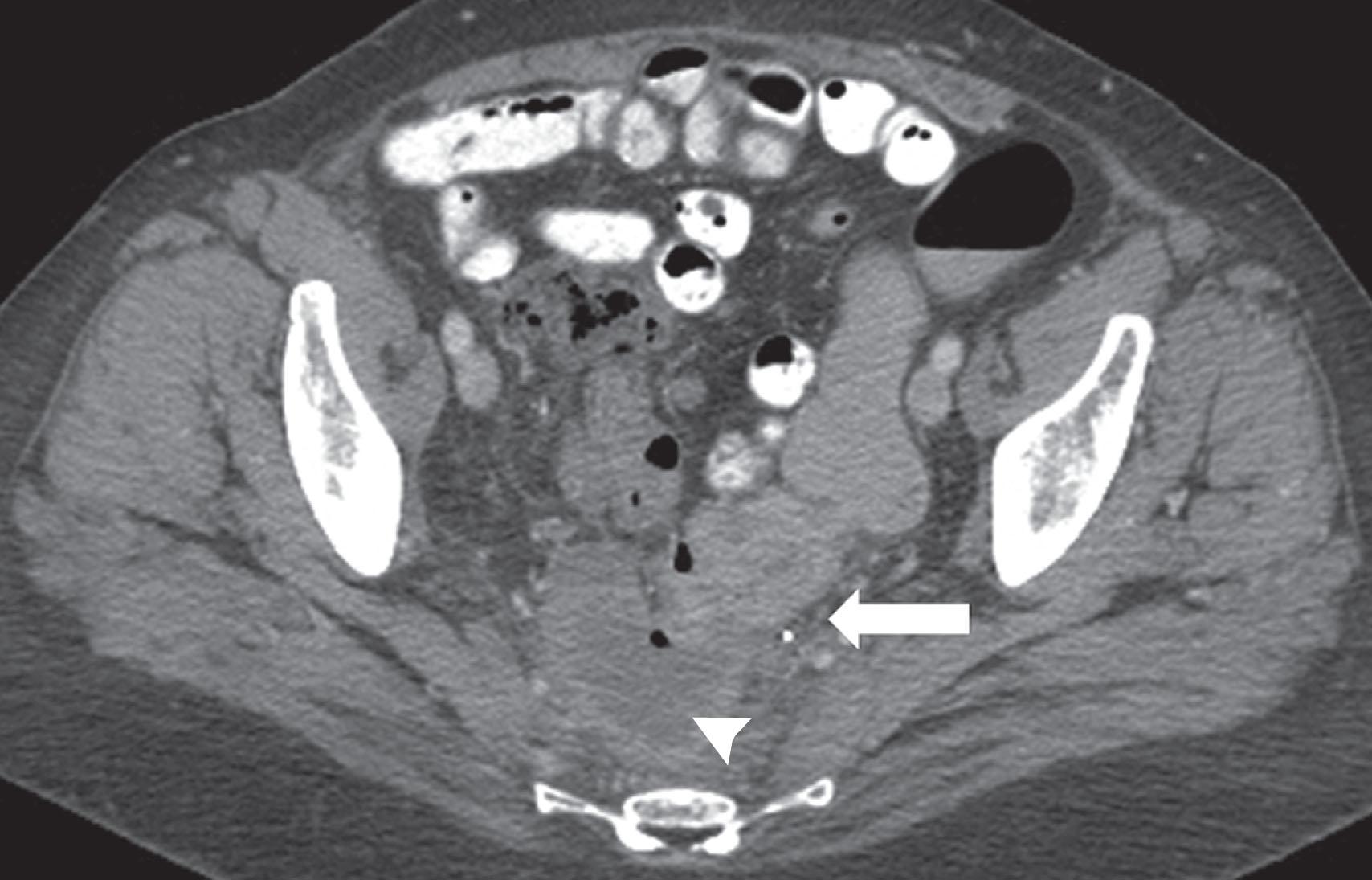 Figure 41.7, Axial contrast-enhanced computed tomography scan from a patient with ovarian cancer treated with a vascular endothelial growth factor–tartrate-resistant acid phosphatase agent shows a fistula between the rectum ( arrow ) and abscess cavity ( oval ).