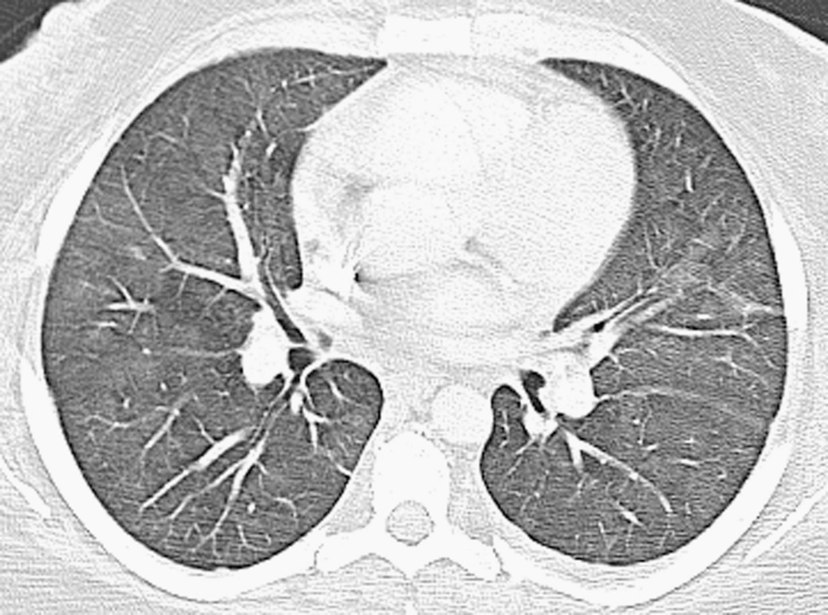 Figure 40.1, Acute drug toxicity. A 40-year-old woman with shortness of breath and fever during the month of new salvage chemotherapy with PTK787, a tyrosine kinase inhibitor, for acute myeloid leukemia. Chest computed tomography (CT) scan shows diffuse bilateral ground-glass opacities. Autopsy performed 9 days after the CT scan demonstrated acute interstitial pneumonitis with diffuse alveolar damage.