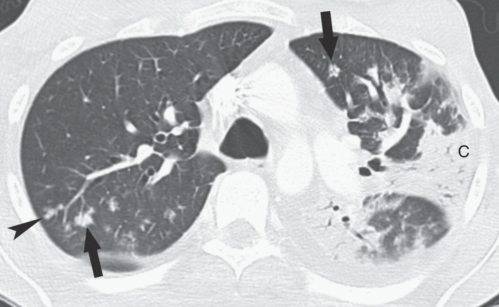 Figure 40.3, Gram-negative bacterial pneumonia. A 25-year-old man with T-cell large granular lymphocytic leukemia presents with neutrophenic fever. Contrast-enhanced chest computed tomography (CT) scan shows left upper lobe consolidation (C), peribronchovascular nodular opacities ( arrows ), and tree-in-bud nodules ( arrowhead ). Cultures from bronchoscopy that was performed on the day of the CT scan grew Enterococcus and Serratia marcescens .