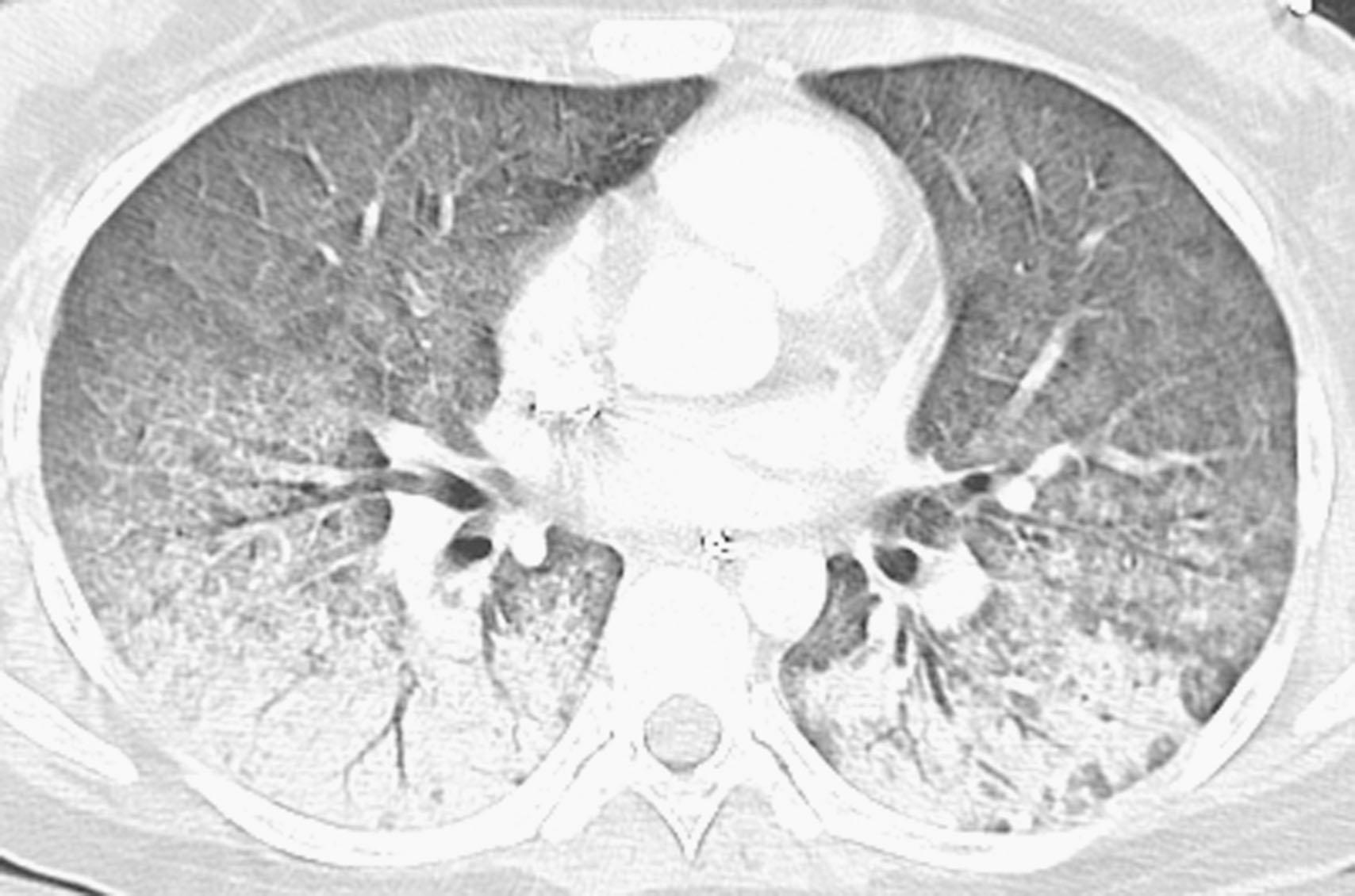 Figure 40.4, Viral pneumonia. A 19-year-old woman with acute lymphocytic leukemia, treated with hypercyclophosphamide, vincristine, doxorubicin, and dexamethasone for relapse, who presented with an abnormal chest radiograph, fever, shortness of breath, and hypoxemia. She had high cytomegalovirus antigenemia. Contrast-enhanced chest computed tomography scan shows diffuse airspace disease with lower lobe consolidation, whereas the rest of the lung shows diffuse ground-glass opacities.