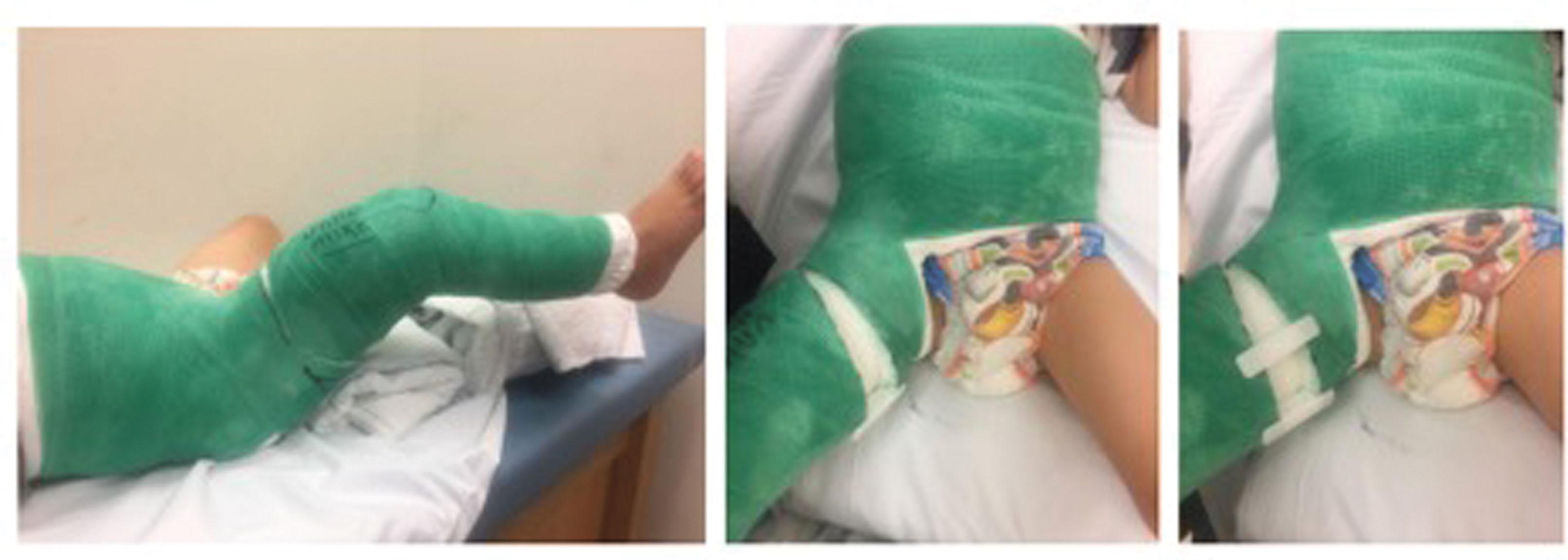 Fig. 11.1, Clinical Photos of Wedging of a Right Single Leg Spica Cast, With Opening of the Wedge Medially to Correct Varus Angulation.