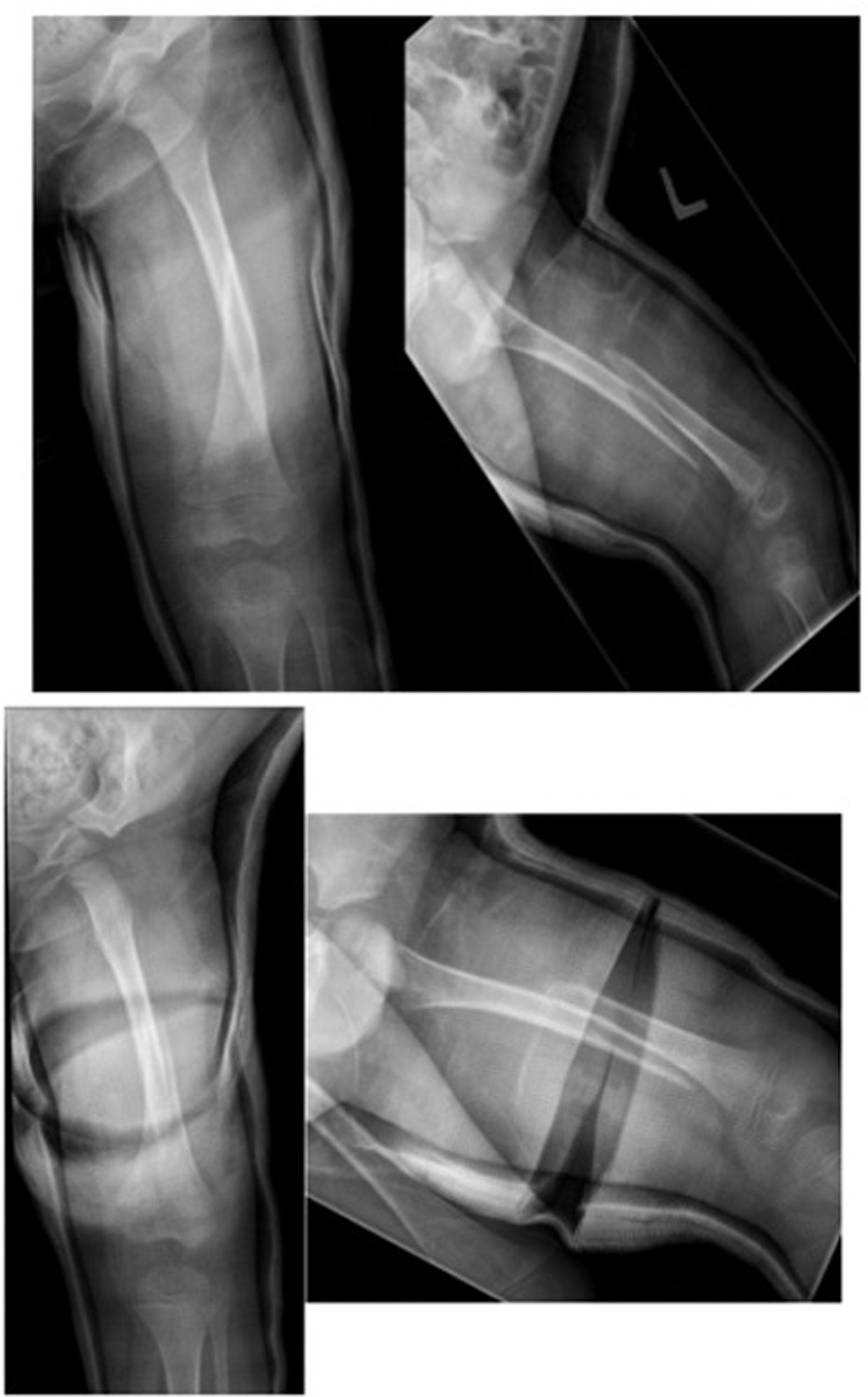 Fig. 11.2, Anteroposterior and Lateral X-Rays of a Left Femur Fracture. This is before and after wedging of a spica cast for a 3-year-old at 1 to 2 weeks’ postoperative follow-up, to prevent additional displacement into varus.