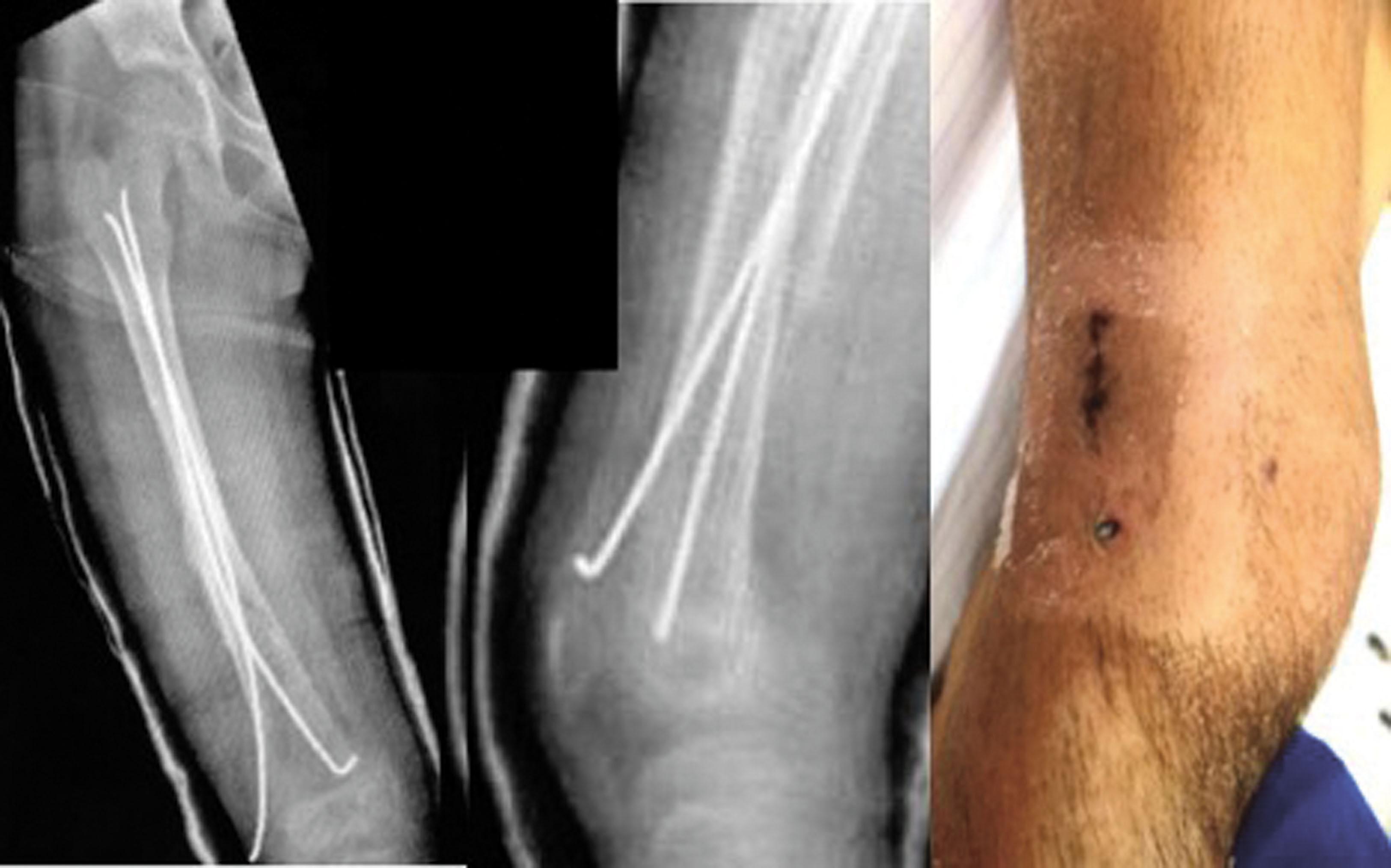 Fig. 11.4, A Prominent Lateral-Entry Retrograde Flexible Nail. Anteroposterior and lateral x-rays, as well as a clinical photo of a 7-year-old female who sustained a right femur fracture at an amusement park and was treated with flexible nailing with placement of a long-leg cast. She had persistent lateral knee pain after 2 weeks, and the cast was removed, revealing that the tip of the rod had eroded through the skin. The tips should be left along the metaphysis above the physis, not bend, and not be prominent.