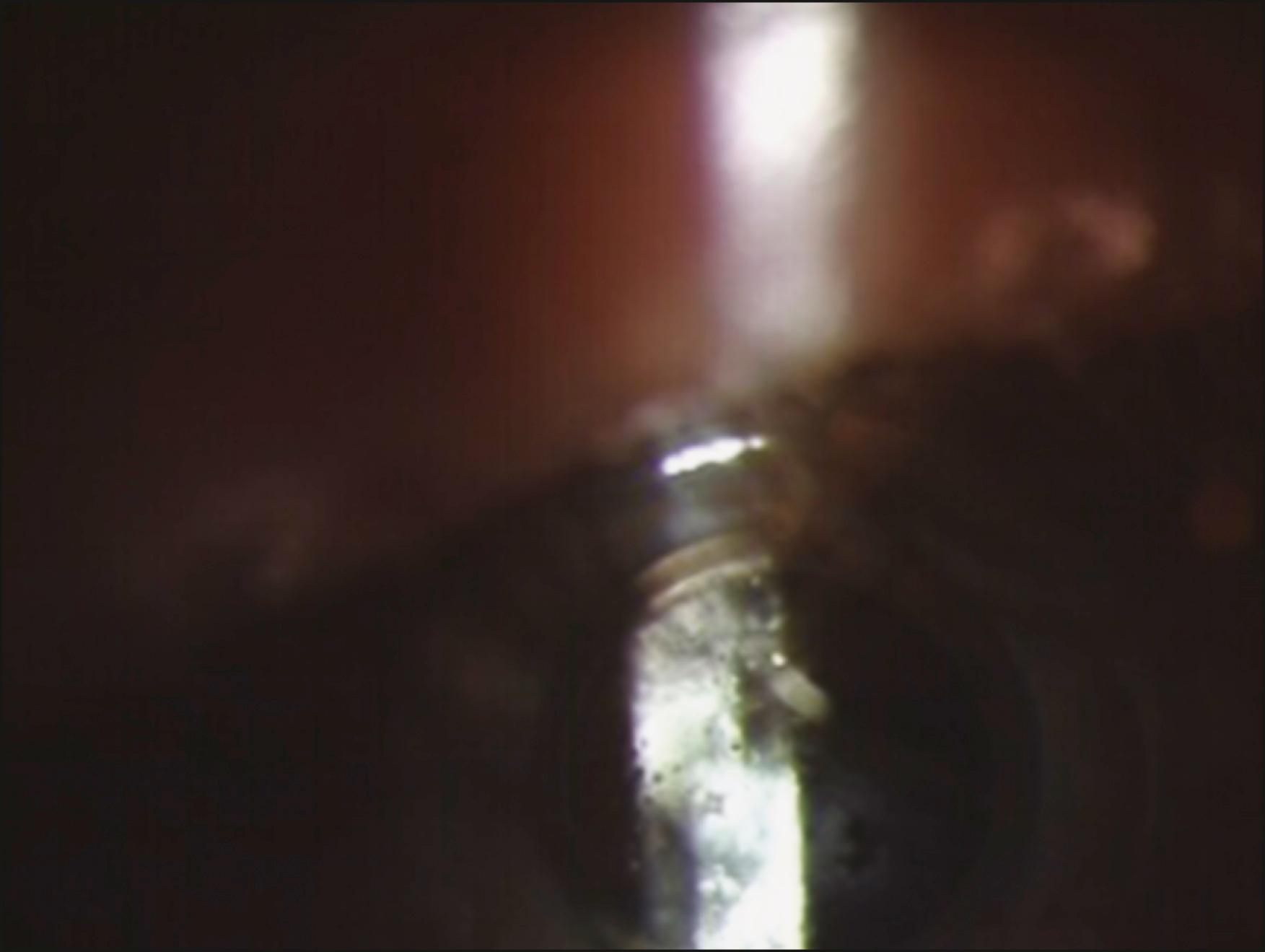 Fig. 158.1, Faint retroprosthetic membrane. Note the white sheen posterior to the optic as the light beam from the slit lamp shines through the Boston keratoprosthesis type 1 optic.