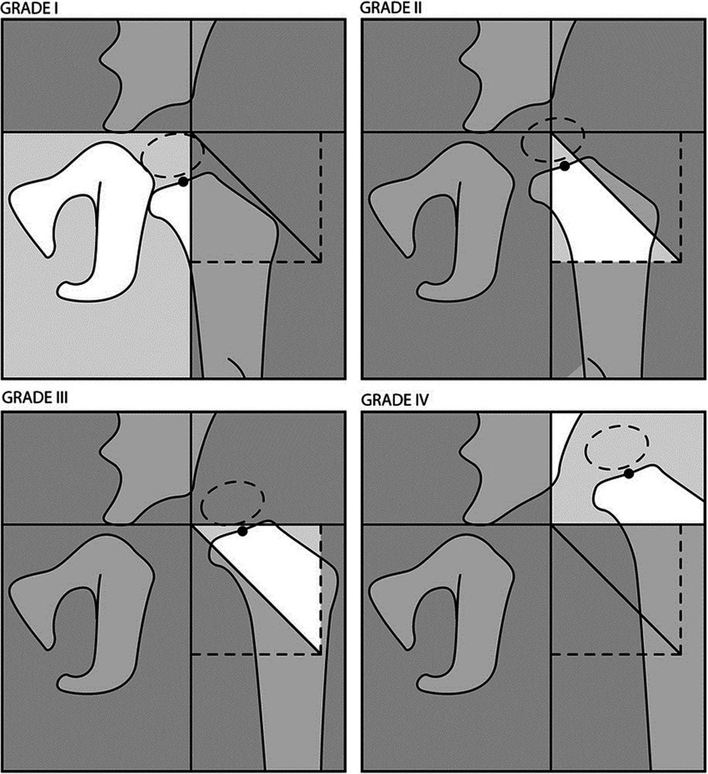 Fig. 26.2, International Hip Dysplasia Institute Anteroposterior Pelvic Radiograph Classification of Developmental Dysplasia of the Hip Severity. Grade I is a normal hip. Grade II is a subluxated hip; the midpoint of the proximal femoral metaphysis lies between Perkin’s line and a diagonal line drawn 45 degrees from the intersection of Perkin’s line and Hilgenreiner’s line. Grade III is a dislocated hip; the midpoint of the proximal femoral metaphysis lies lateral to the diagonal line drawn 45 degrees from the intersection of Perkin’s line and Hilgenreiner’s line, but below Hilgenreiner’s line. Grade IV is a high dislocation with the midpoint of the proximal femoral metaphysis lying above Hilgenreiner’s line.