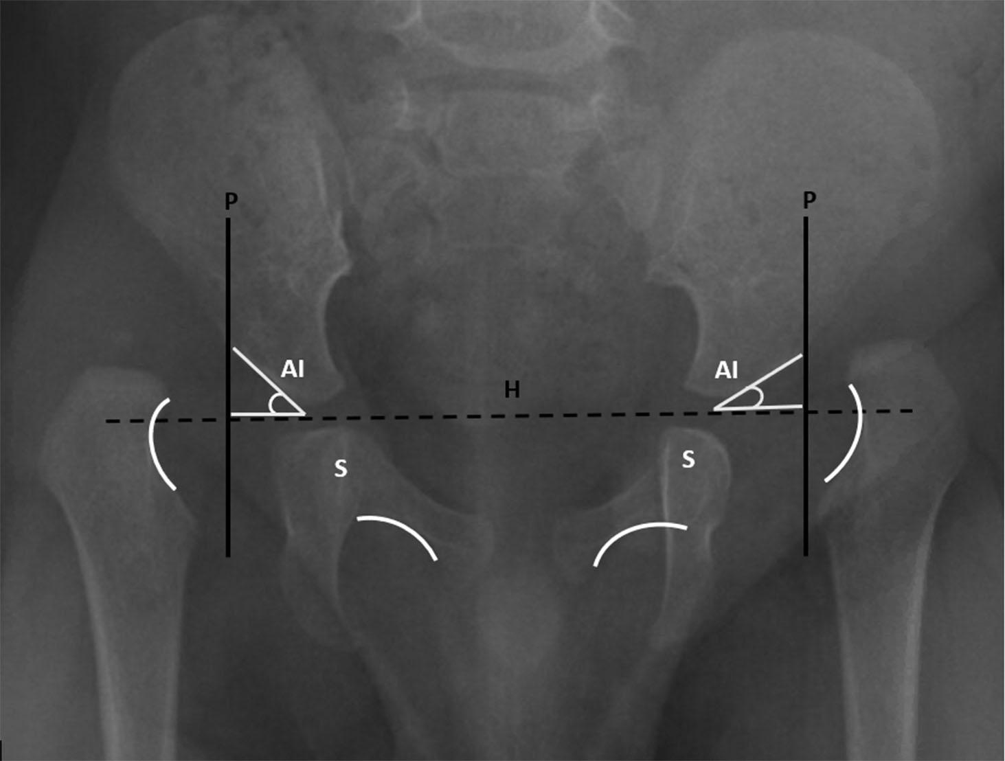 Fig. 26.3, Anteroposterior Pelvic Radiograph of an 8-Month-Old Male With International Hip Dysplasia Institute Grade 4 Bilateral Hip Dysplasia. The radiograph demonstrates the classic radiographic lines when evaluating for developmental dysplasia of the hip. Hilgenreiner’s line is a horizontal reference line between the triradiate cartilages. Perkin’s line is a line perpendicular to Hilgenreiner’s line at the lateral corner of the acetabulum. The acetabular index is an angle created by a tangent to the bony acetabular roof and Hilgenreiner’s line. Shenton’s line is an imaginary line created by the undersurface of the superior pubic ramus and the inferomedial aspect of the femoral neck. Normally Shenton’s line should be continuous, so a break in the line, as shown above bilaterally, demonstrates hip subluxation or dislocation.