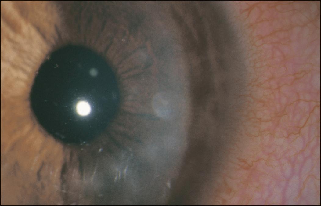 Complications of Contact Lens Wear Clinical Tree