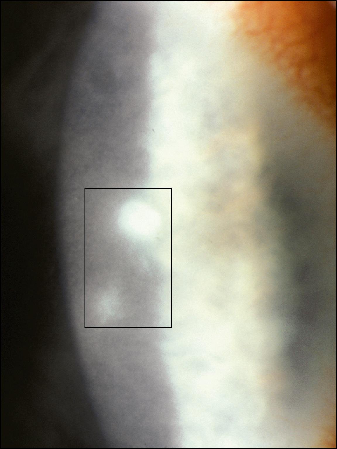 Fig. 99.4, Pseudomonas infection was the cause of small infiltrates (box) in a patient using disposable lenses for extended wear.