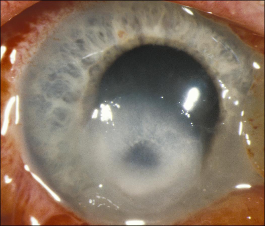 Fig. 99.5, A severe Pseudomonas infection occurred in a daily-wear disposable lens user who mistook saline for disinfecting solution.