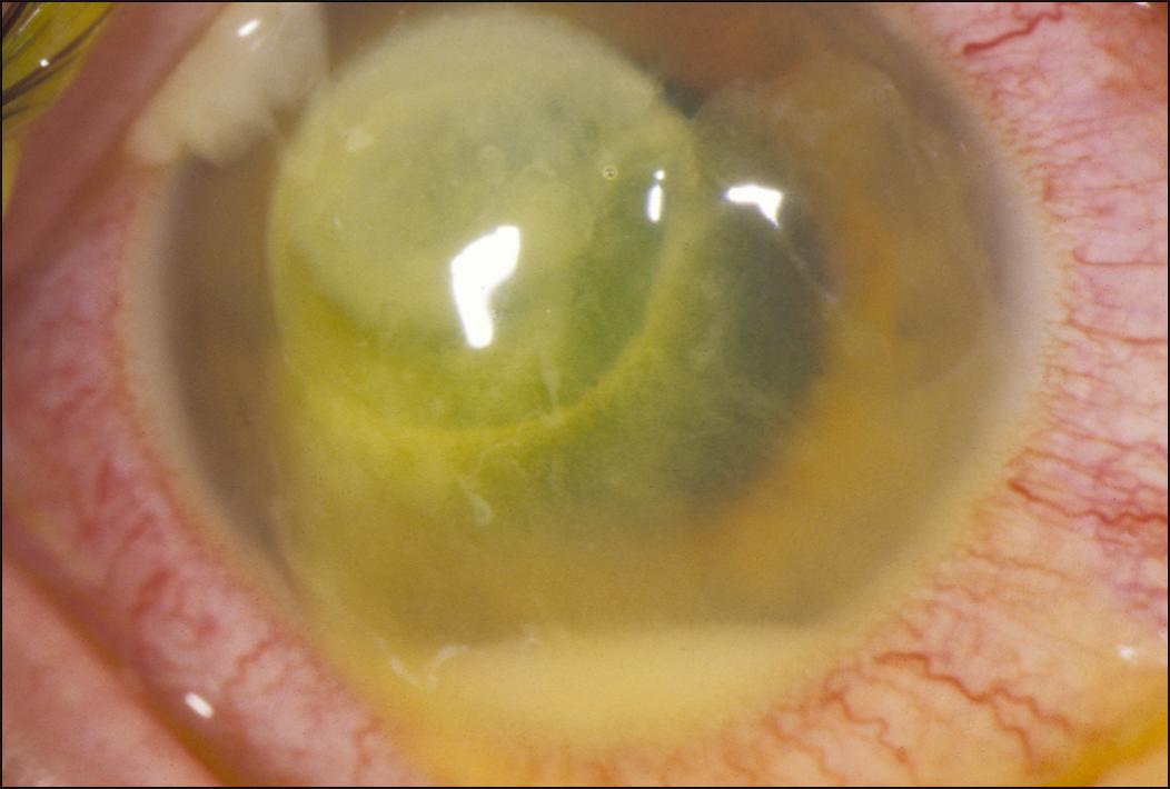 Fig. 99.6, This large, central ulcer initially presented as an abrasion and was treated with tobramycin–dexamethasone combination suspension.