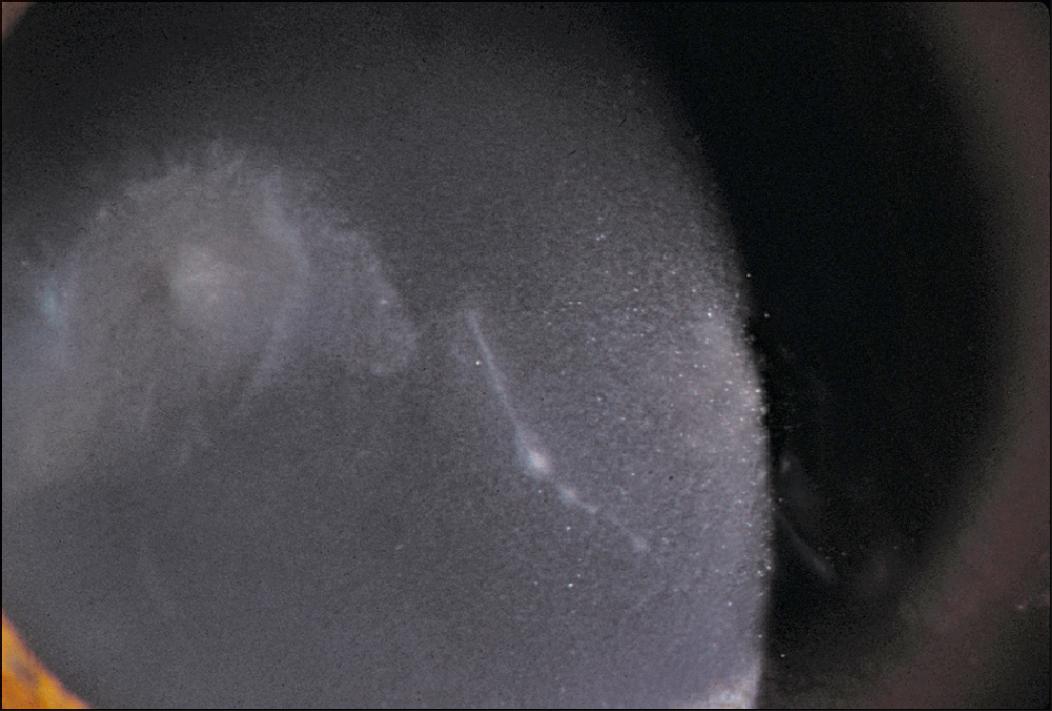 Fig. 99.7, This large paracentral ulcer and radial keratoneuritis presented in a daily-wear lens wearer who correctly cared for her lenses.