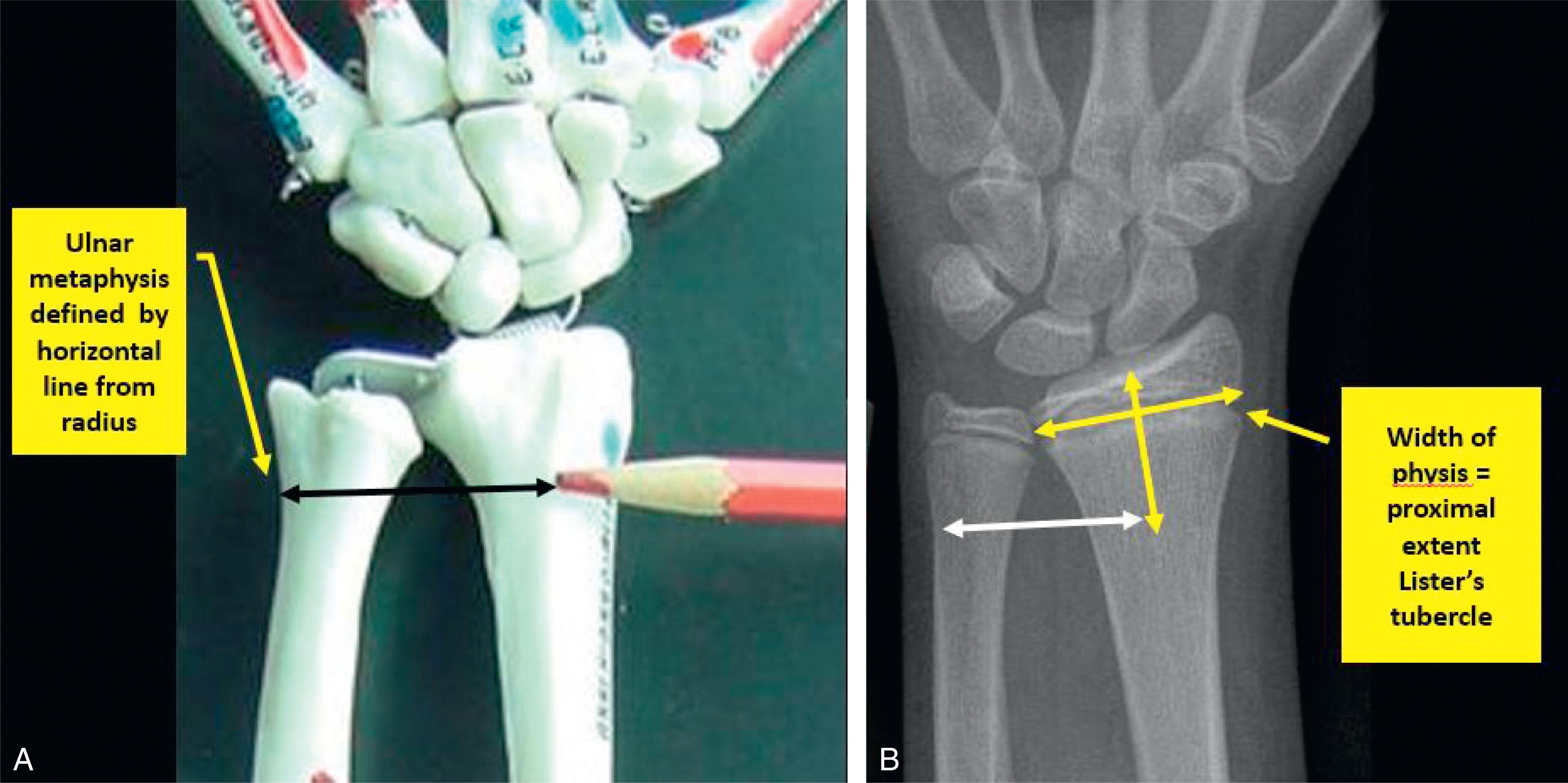 Fig. 6.1, Anatomic Definition of Distal Radius and Ulna Fractures. (A) Anatomic model showing key landmark of proximal extent of Lister’s tubercle. (B) Corresponding radiographic definition.