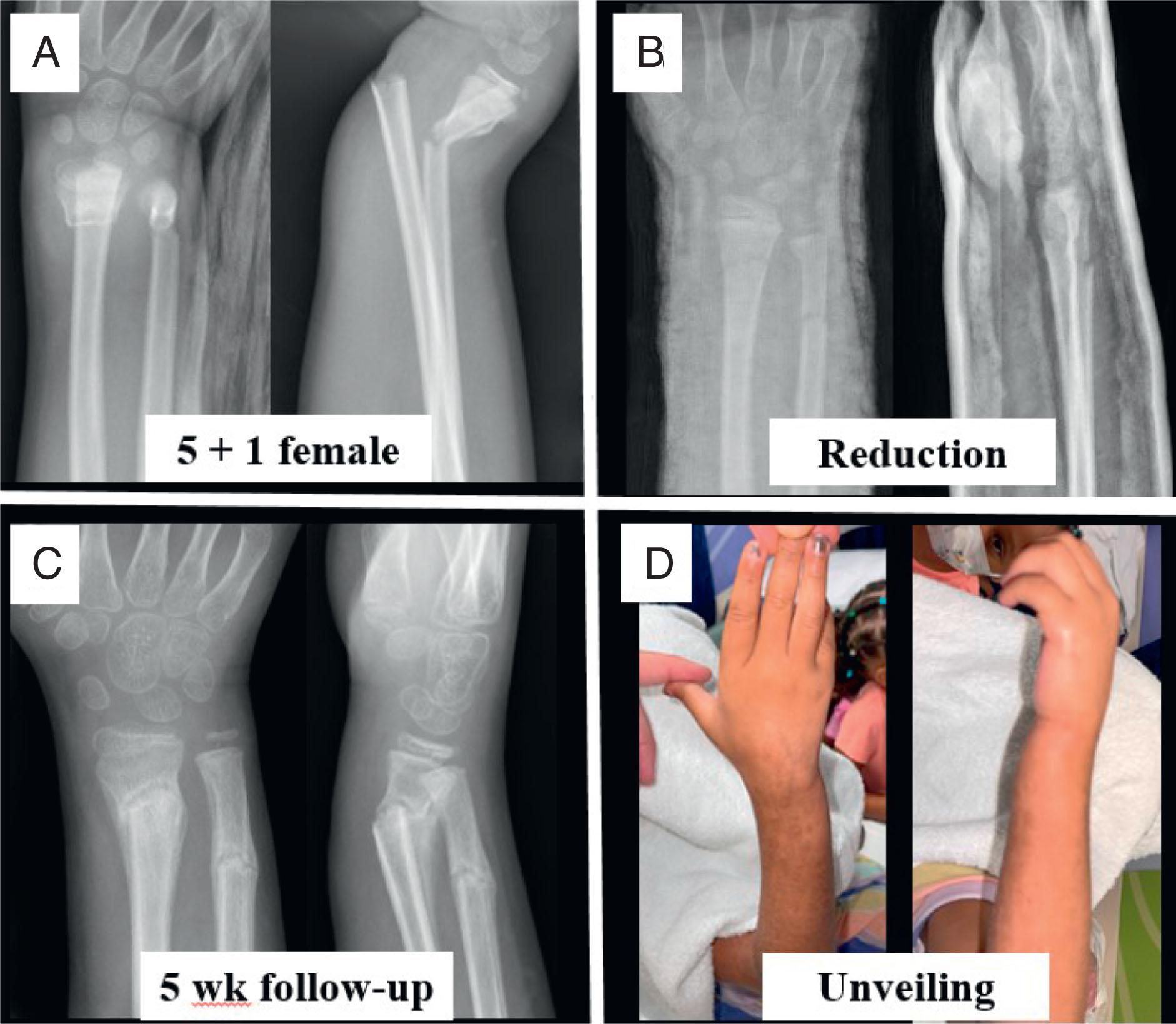 Fig. 6.11, Unveiling of Distal Radius Fracture That Developed Malalignment. (A) A 5-years-and-1-month–old female with closed distal radius and ulna fractures. (B) Initial anatomic reduction. (C) Loss of reduction detected at 5 weeks’ follow-up. (D) Unveiling reveals minimal clinical deformity that reassures family, and continued nonoperative care is undertaken.