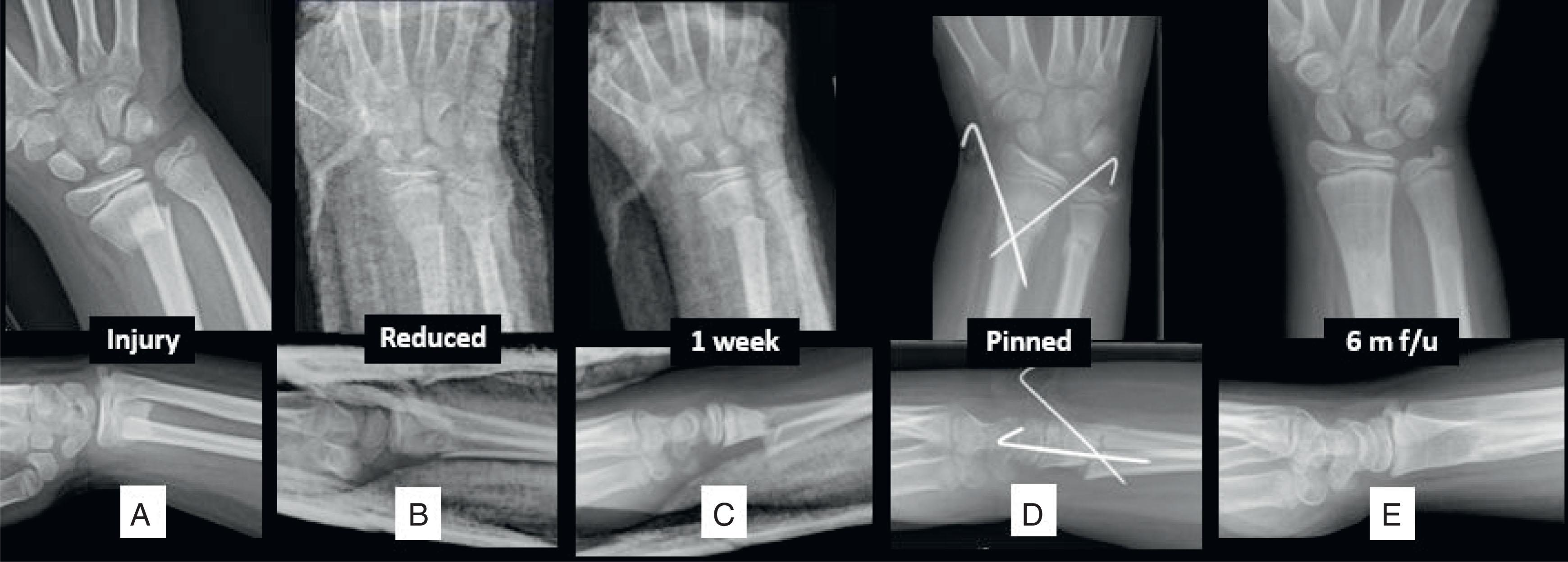Fig. 6.12, Early Loss of Reduction Followed by Closed Reduction and Percutaneous Pinning. (A) A 9-years-and-9-months–old male presents with completely displaced radius with relatively intact ulna. (B) Initial reduction judged to be satisfactory. (C) Malreduction noted at 1 week’s follow-up. (D) Closed reduction and percutaneous pinning and below elbow casting performed subsequently. (E) Six months’ follow-up showing anatomic alignment.