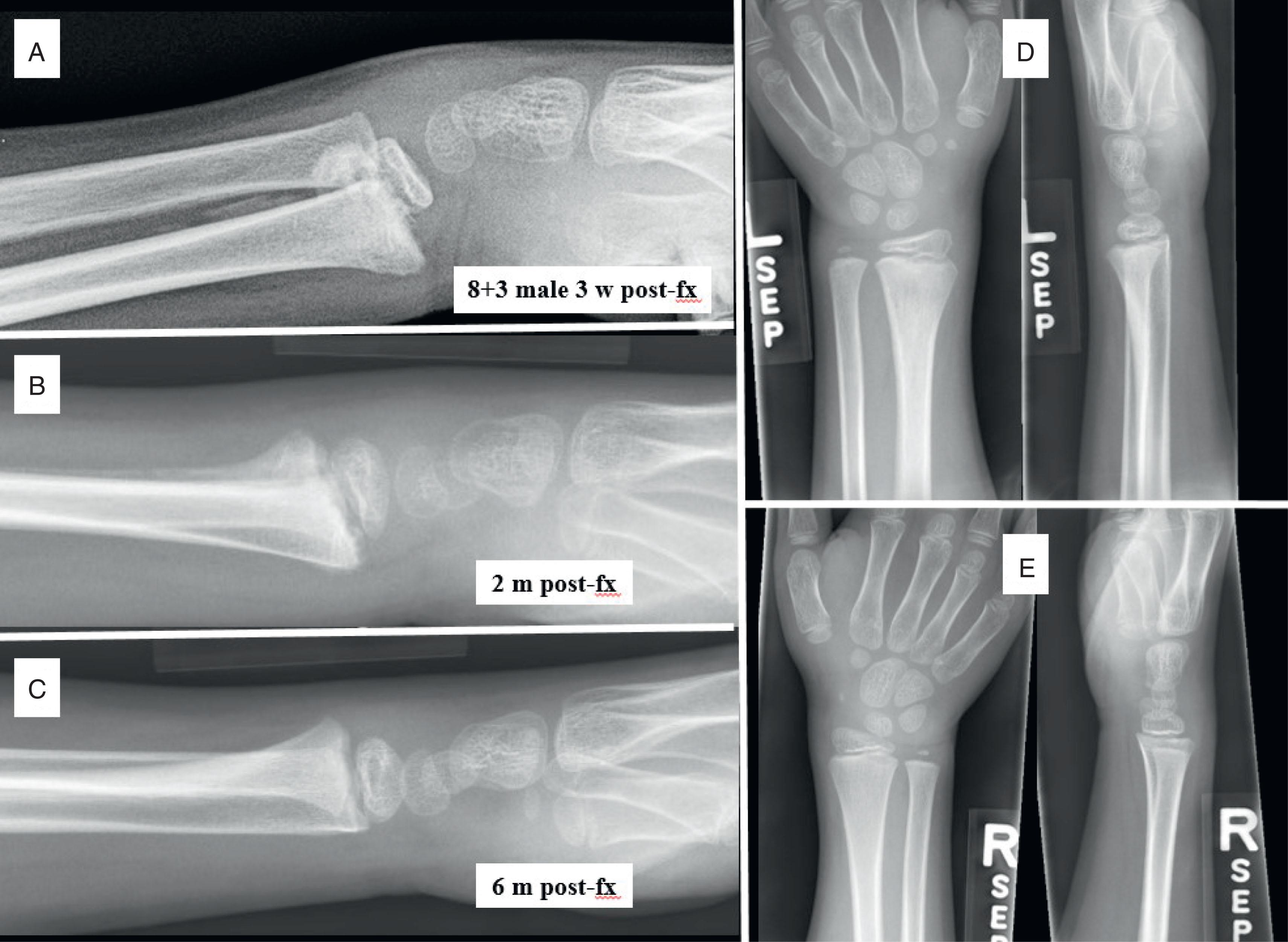 Fig. 6.13, Greater Than 50% Displaced Distal Radius Salter-Harris II Fracture Remodels. (A) An 8-year-old male presents late with displaced distal radius growth plate fracture. Early callus is apparent. (B) Two-month follow-up lateral radiograph. (C) Six-month follow-up lateral radiograph. (D) Anteroposterior (AP) and lateral images of injured left side at 6 months. (E) AP and lateral images of right side for comparison at 6 months.