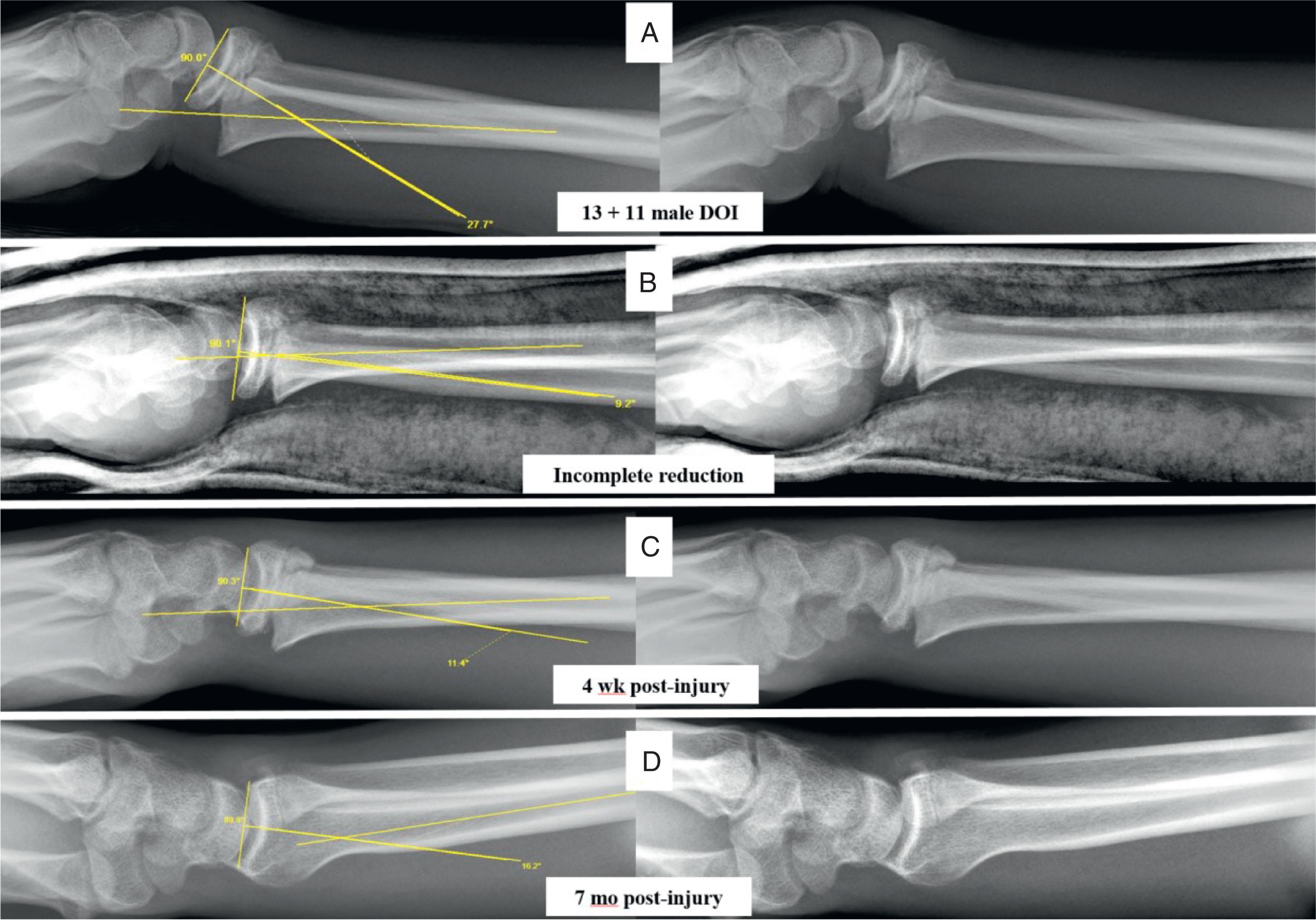 Fig. 6.14, Unreliable Remodeling Potential Following Distal Radius Growth Plate Fracture in Teenager. (A) Initial sagittal displacement with nearly 30 degrees of angulation. (B) Reduction decreased angulation to about 10 degrees. (C) Some increase in angulation at fracture healing. (D) Physis closed and 15-degree apex volar angulation a short time later.