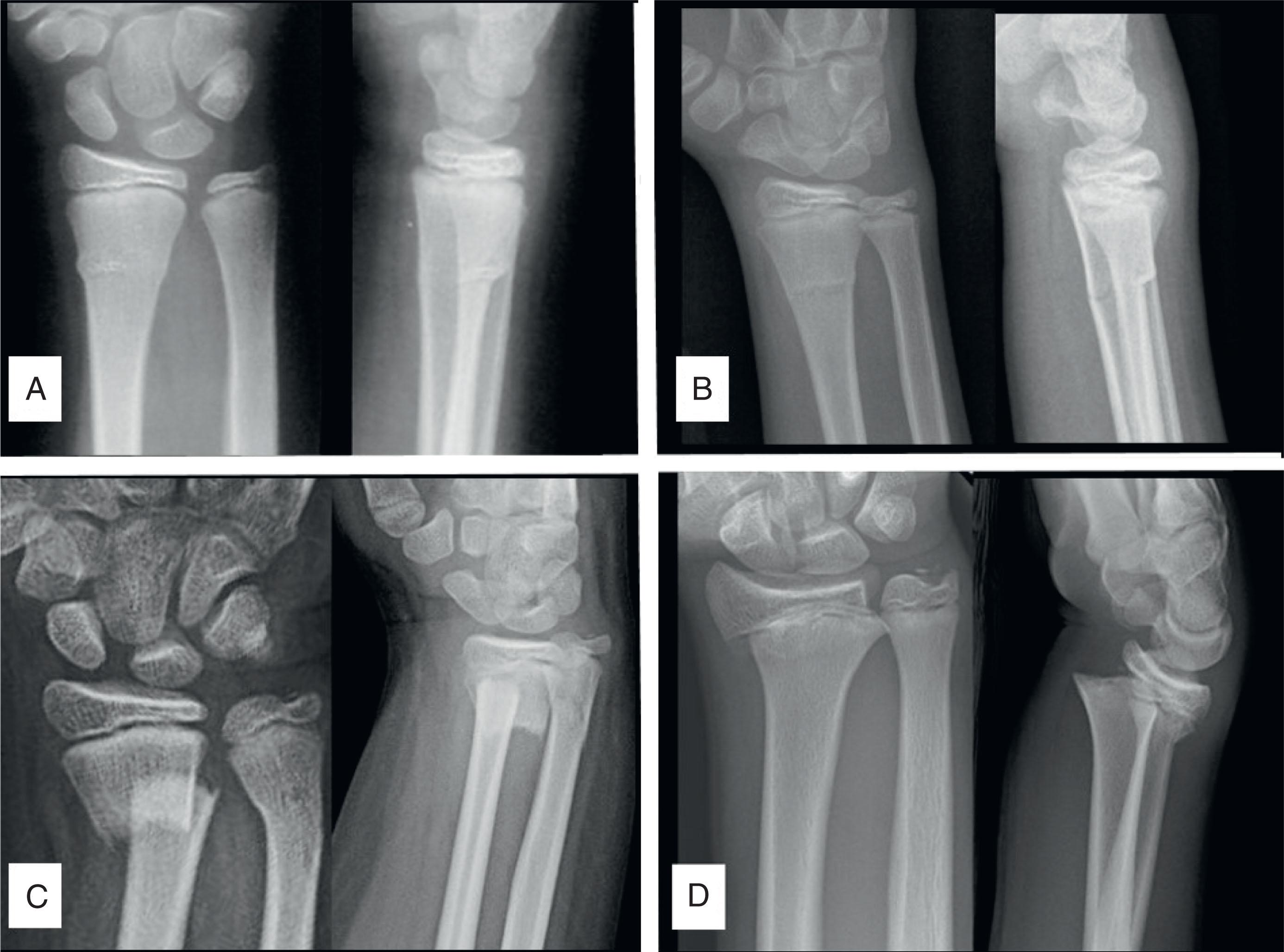 Fig. 6.2, Four Basic Distal Radius Fracture Types. (A) Buckle (aka torus) fracture. (B) Greenstick fracture. (C) Complete fracture. (D) Growth plate fracture.