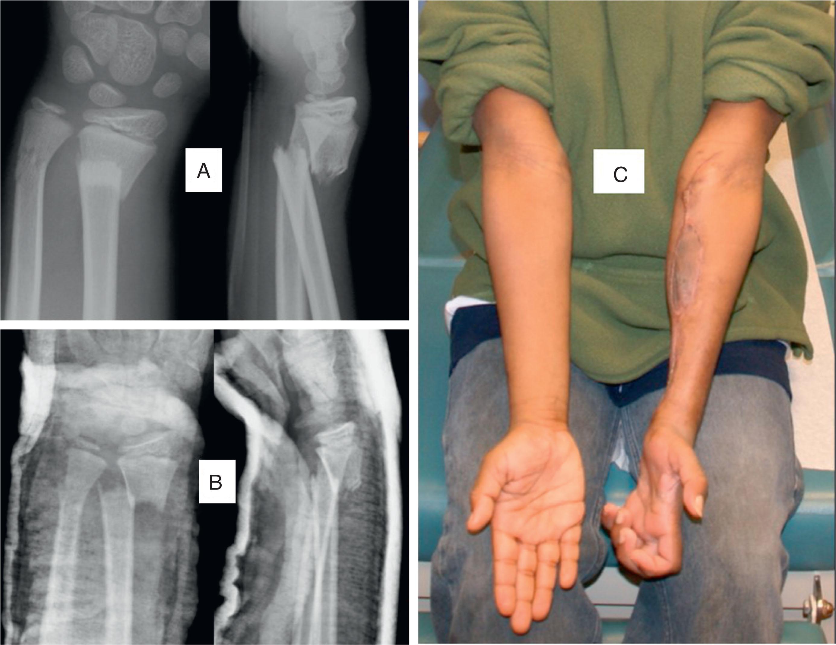 Fig. 6.3, A 9-year-old male sustained closed displaced left distal radius and ulna fractures playing backyard football. (A) Injury anteroposterior and lateral radiographs. (B) Splinted anteroposterior and lateral radiographs following reduction effort by an adult orthopaedic surgeon. (C) Four days later the patient presented with Volkmann ischemic contracture. Clinical appearance following efforts at compartment releases, debridement of necrotic tissue, and skin grafting.